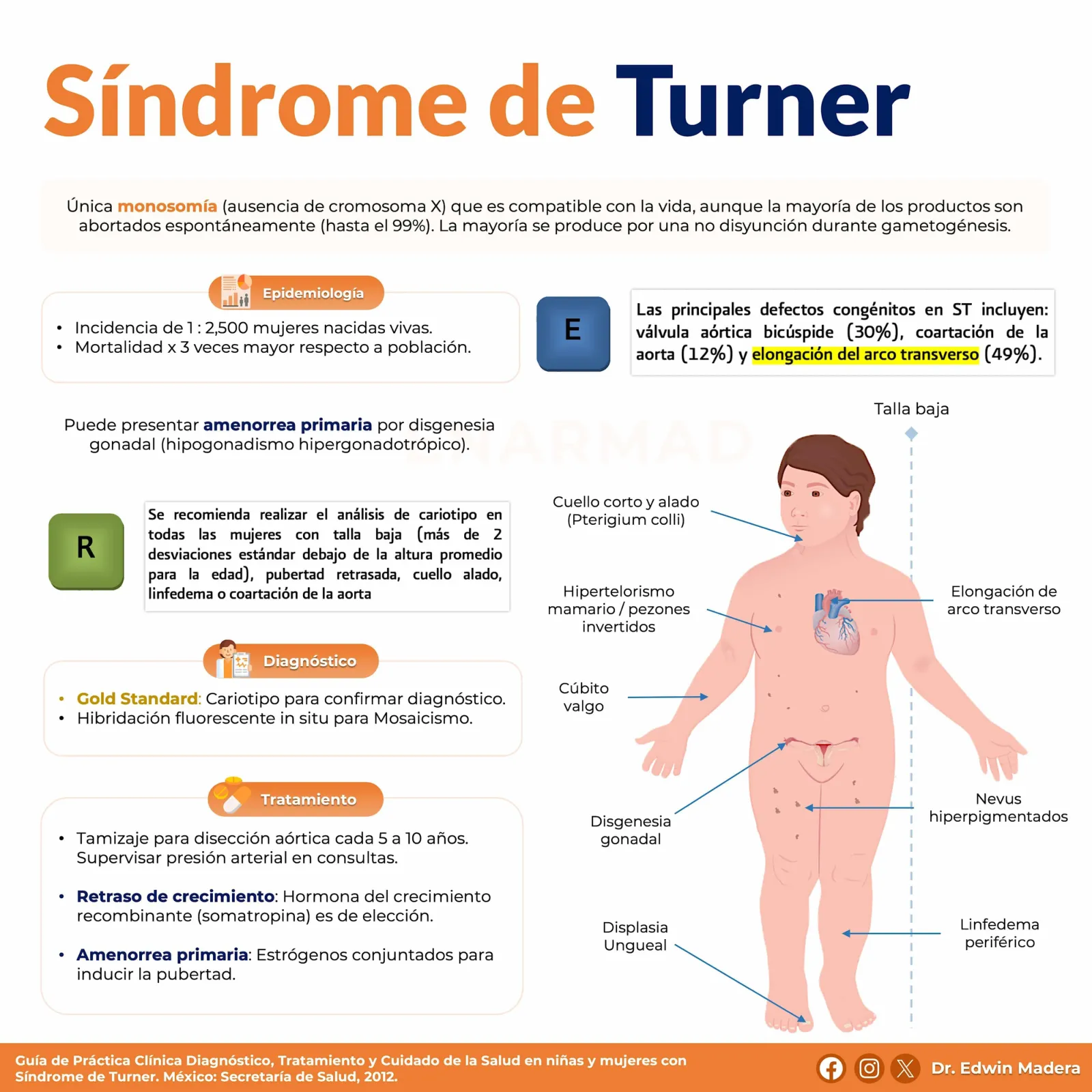 Síndrome de Turner