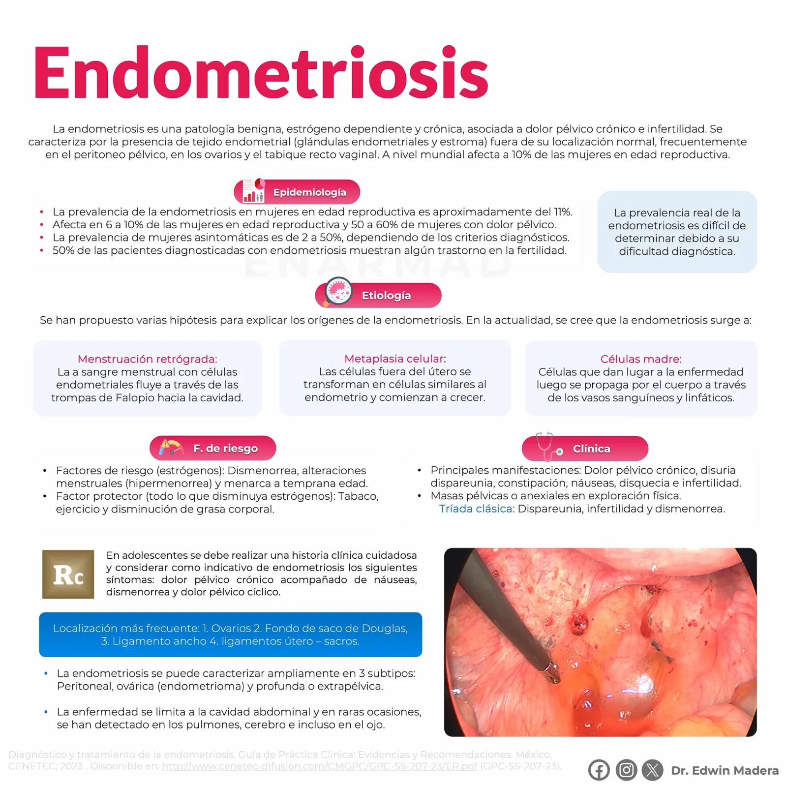 Endometriosis