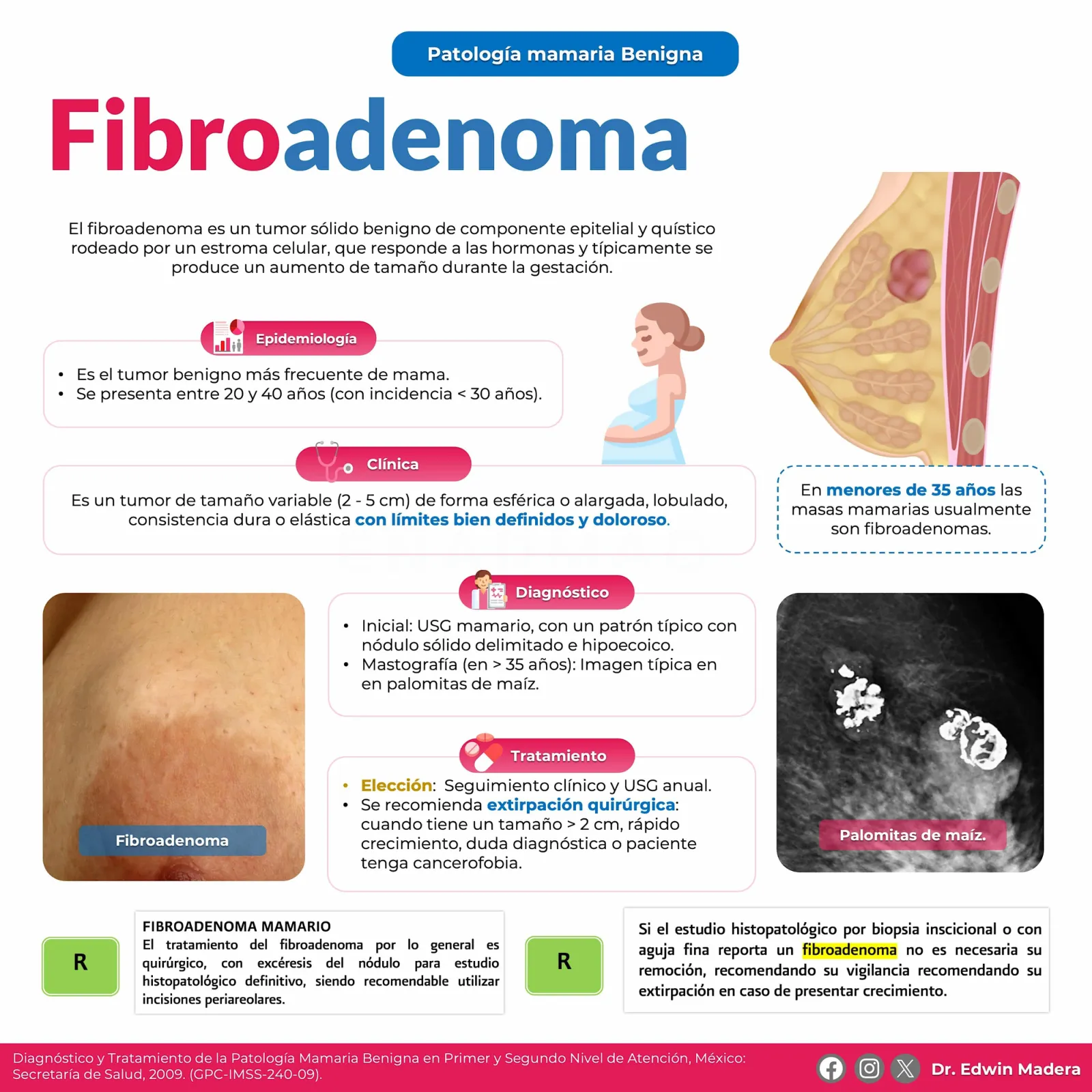 Fibroadenoma