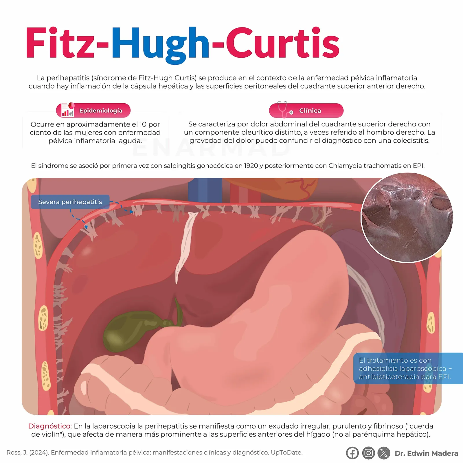 Fitz-Hugh-Curtis