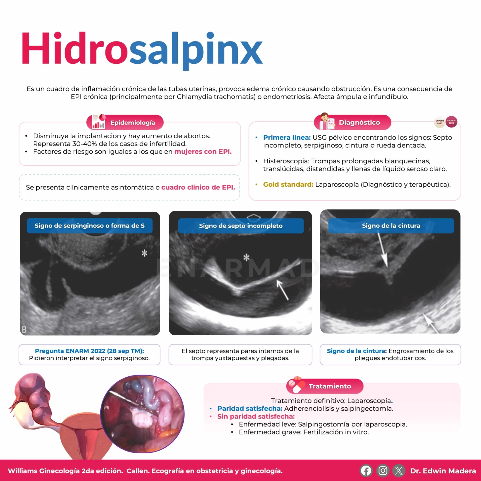 Hidrosalpinx