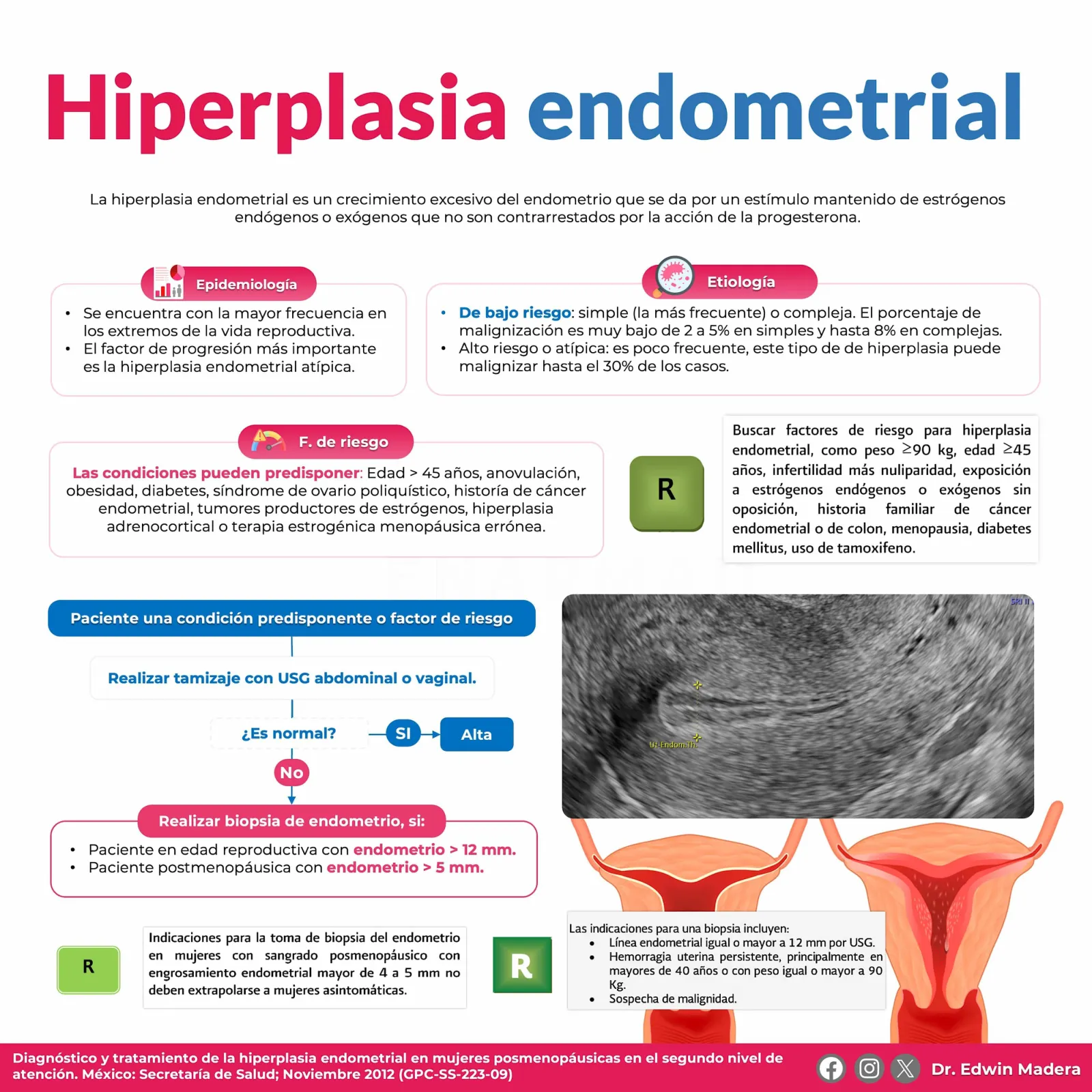 Hiperplasia endometrial