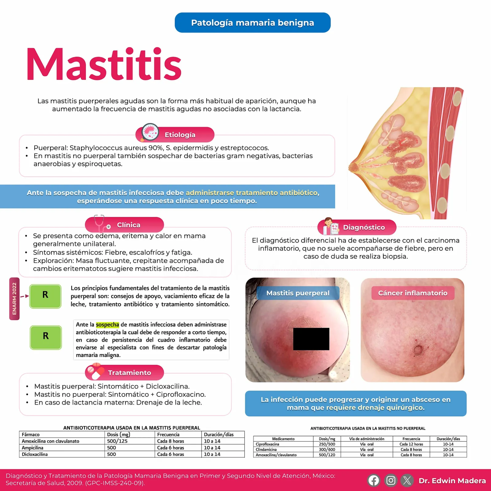 Mastitis