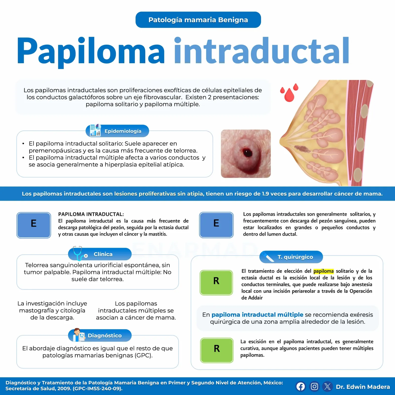 Papiloma intraductal