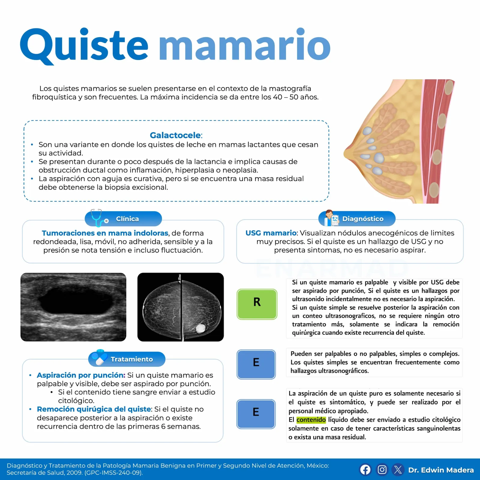 Quiste mamario