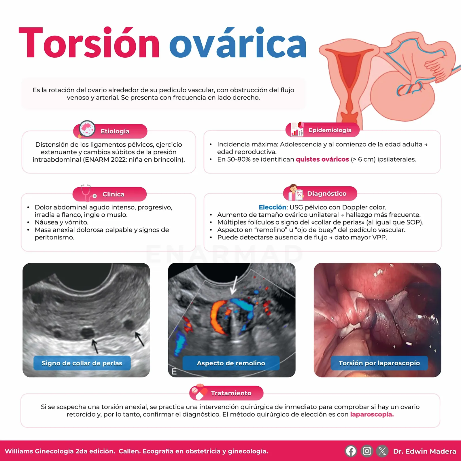 Torsión ovárica