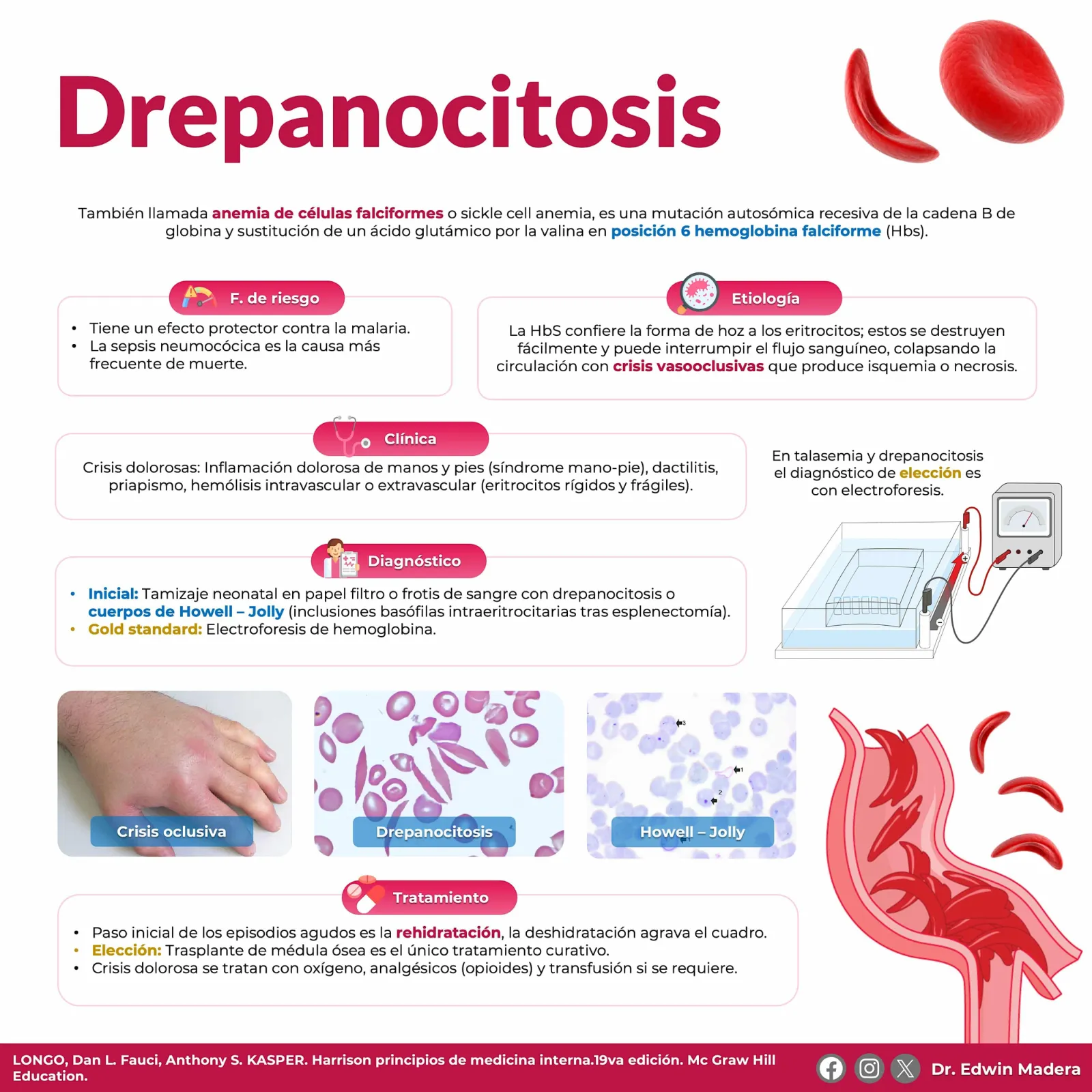 Drepanocitosis