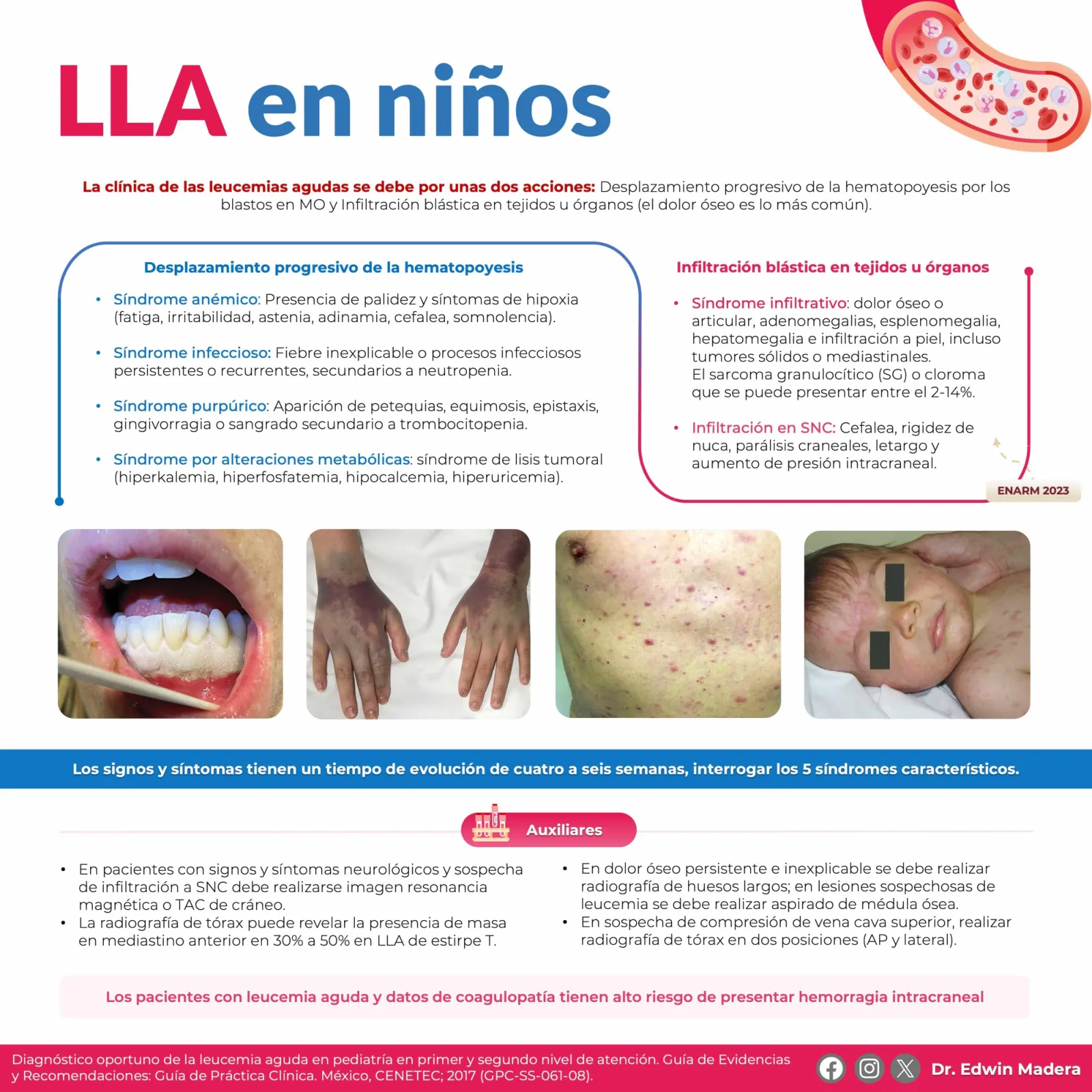 Leucemia linfoblástica aguda