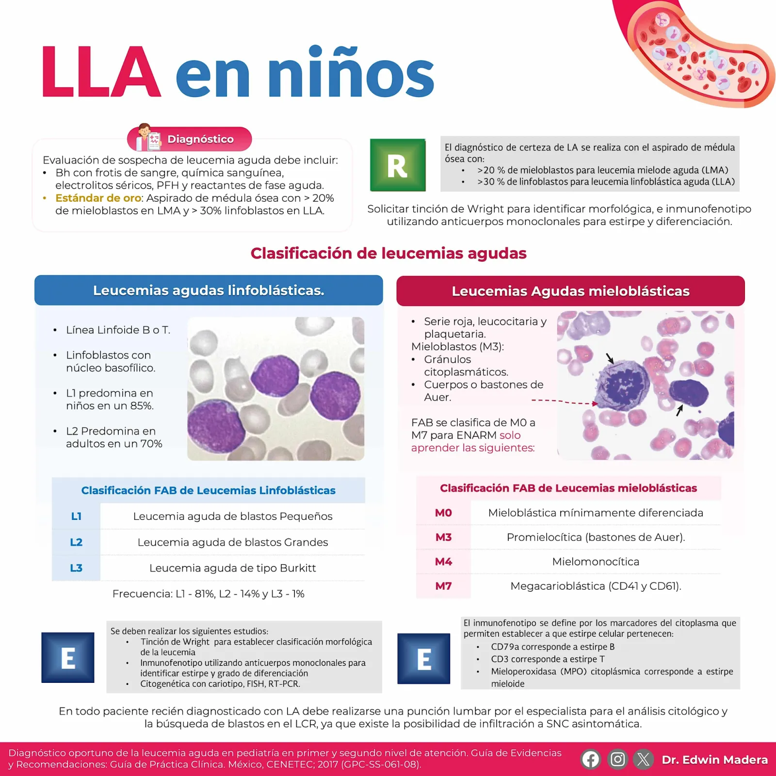 Leucemia linfoblástica aguda
