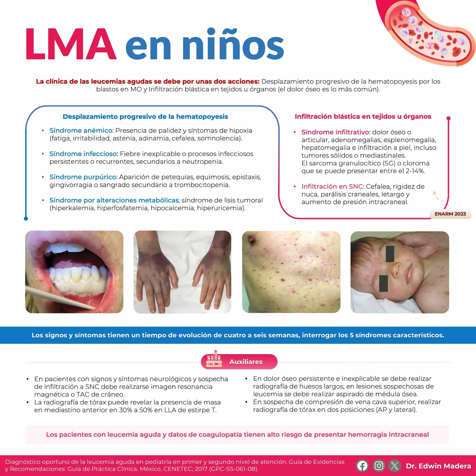 Leucemia mieloblástica aguda