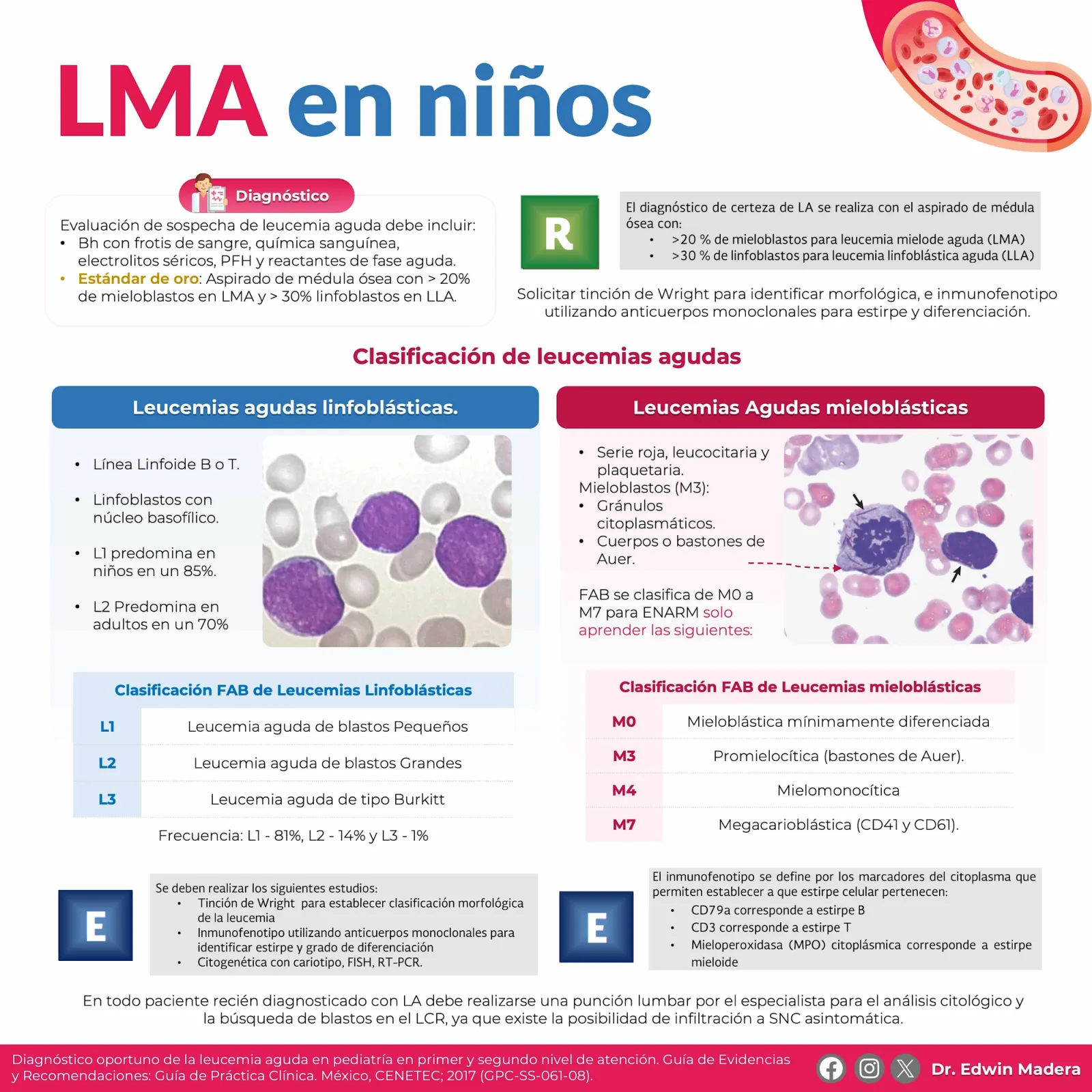 Leucemia mieloblástica aguda