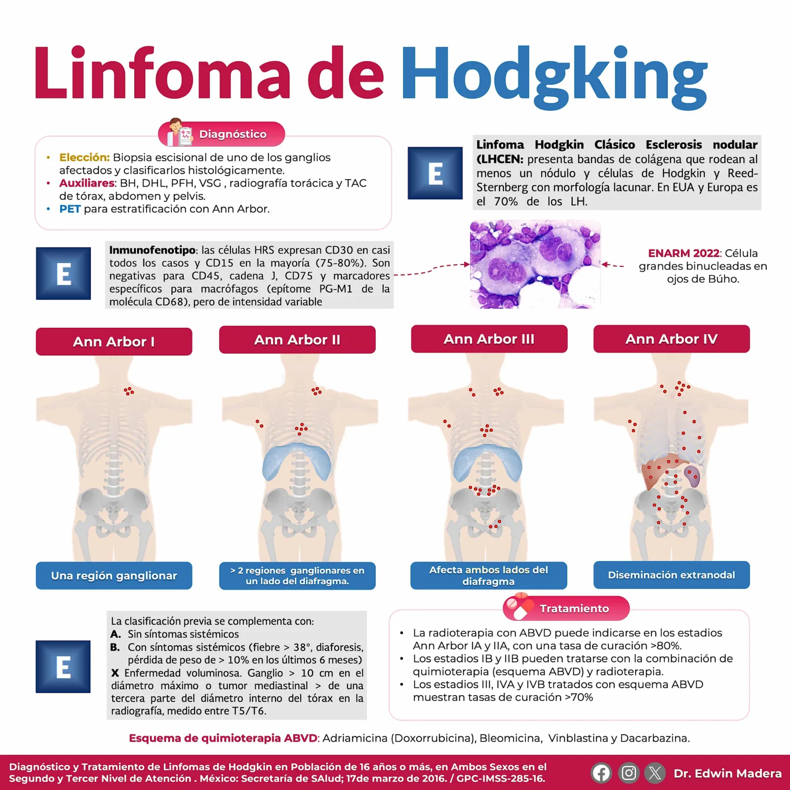 Linfoma de Hodgking