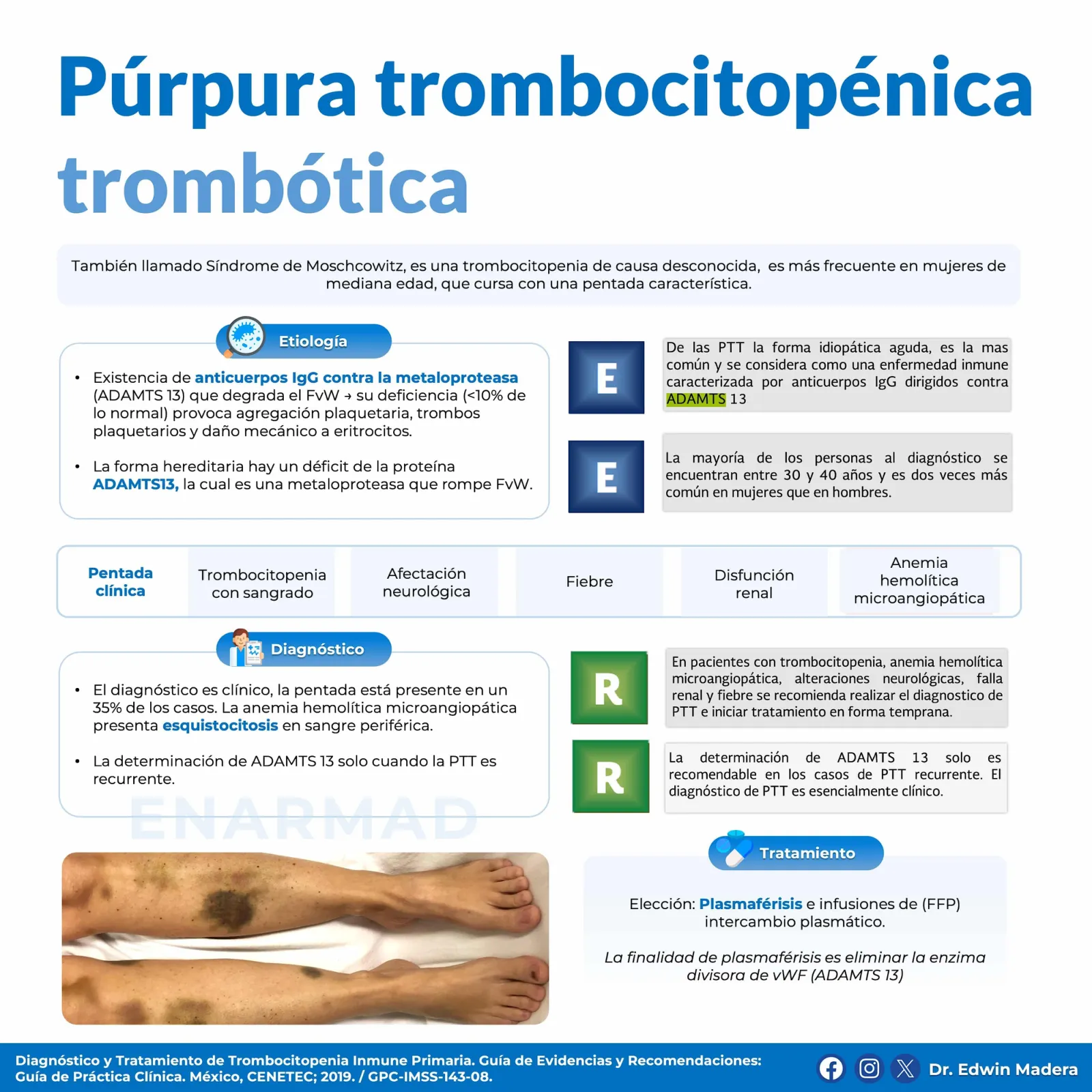 Púrpura trombocitopénica trombótica