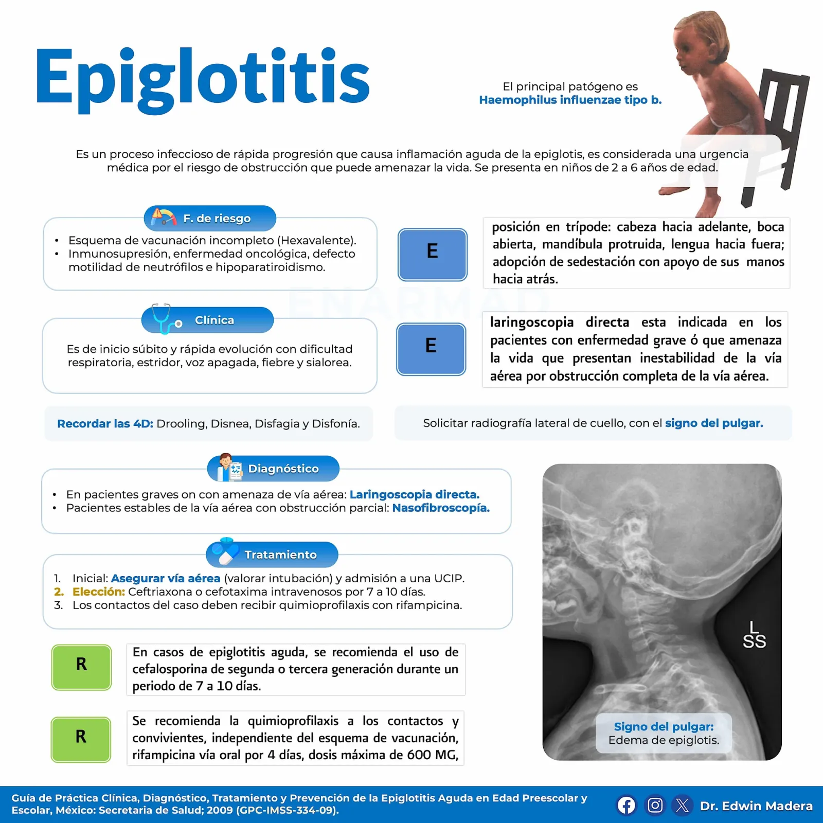Epiglotitis