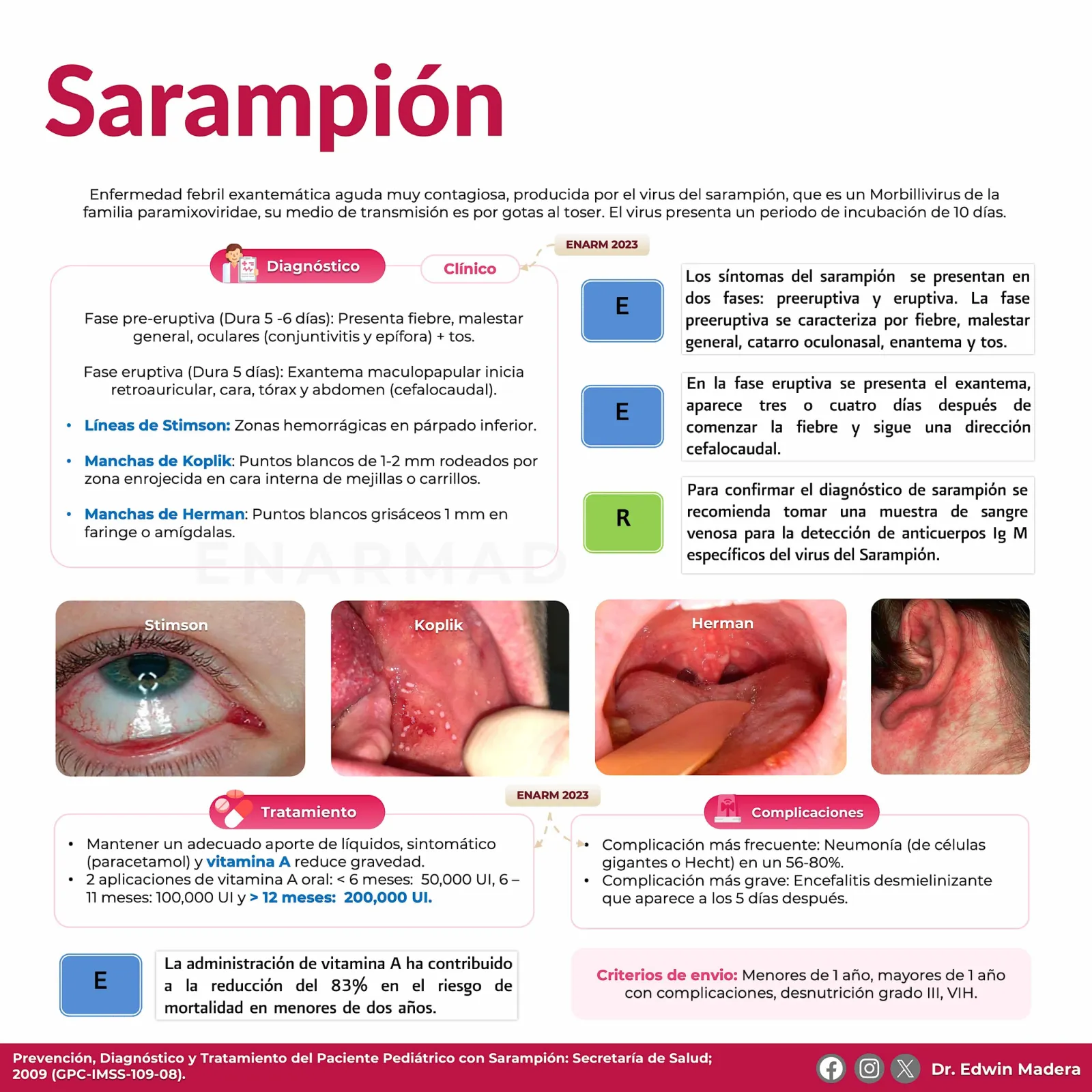 Sarampión