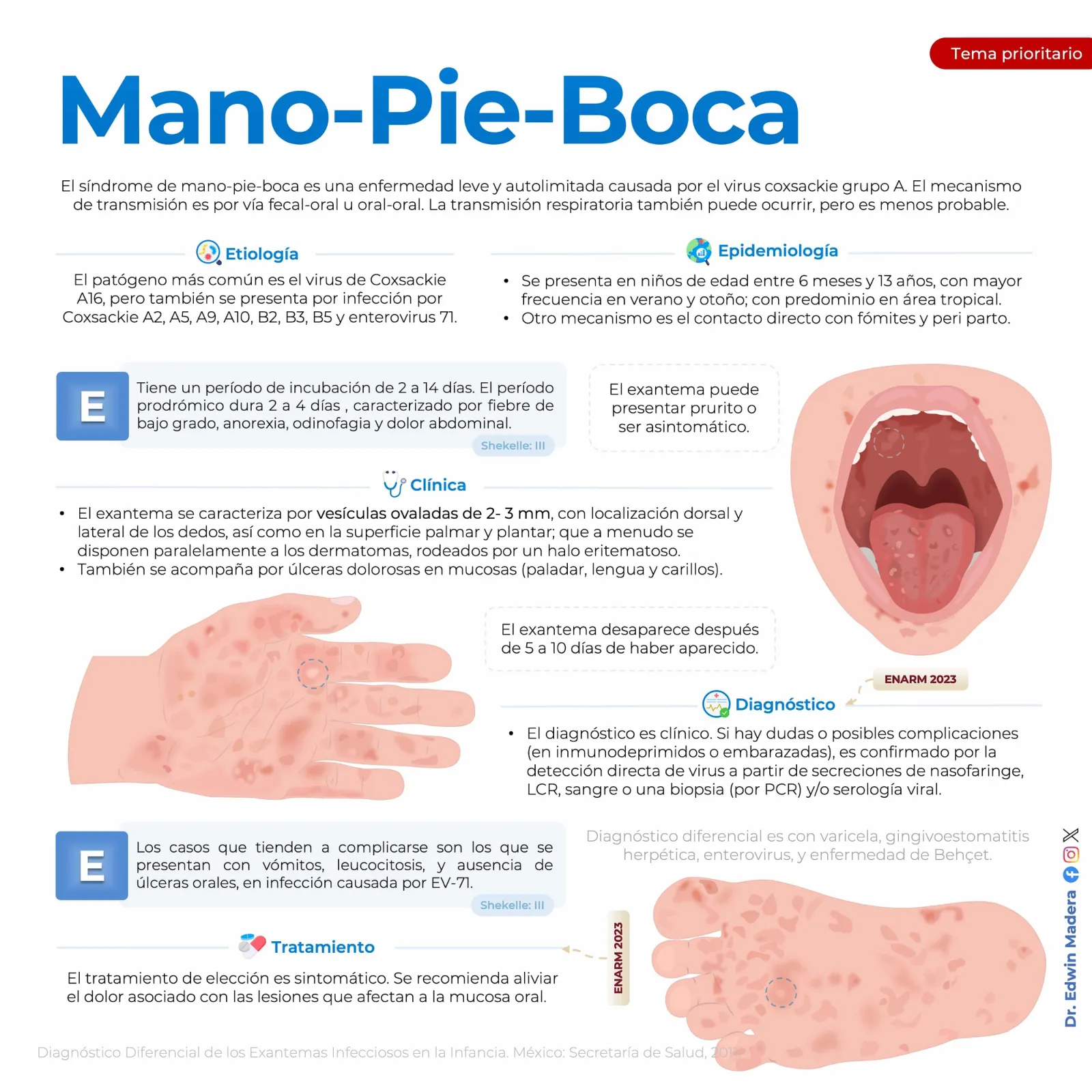 Síndrome mano pie boca