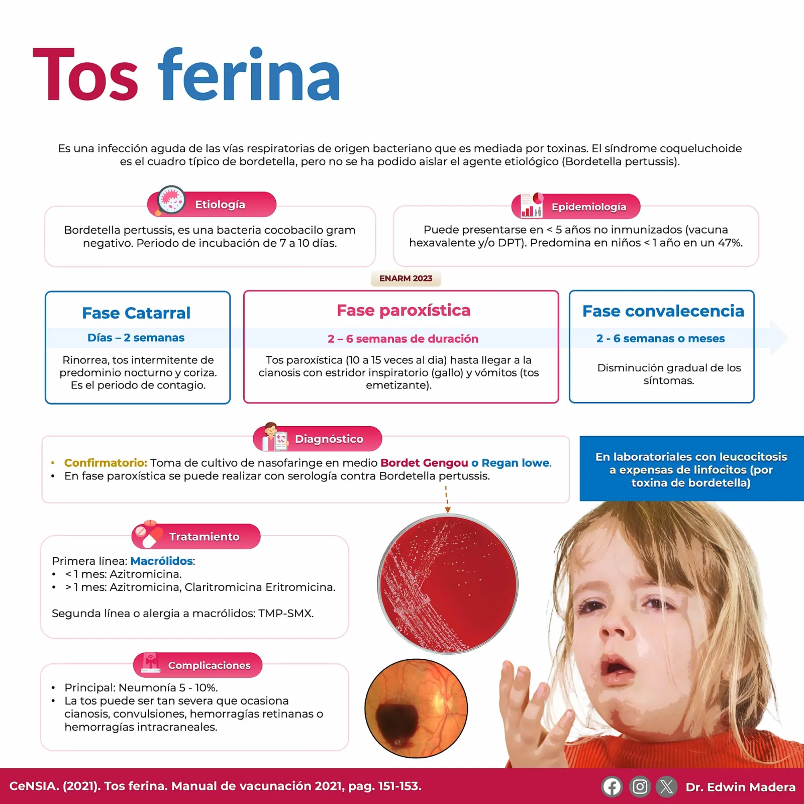 Tos ferina