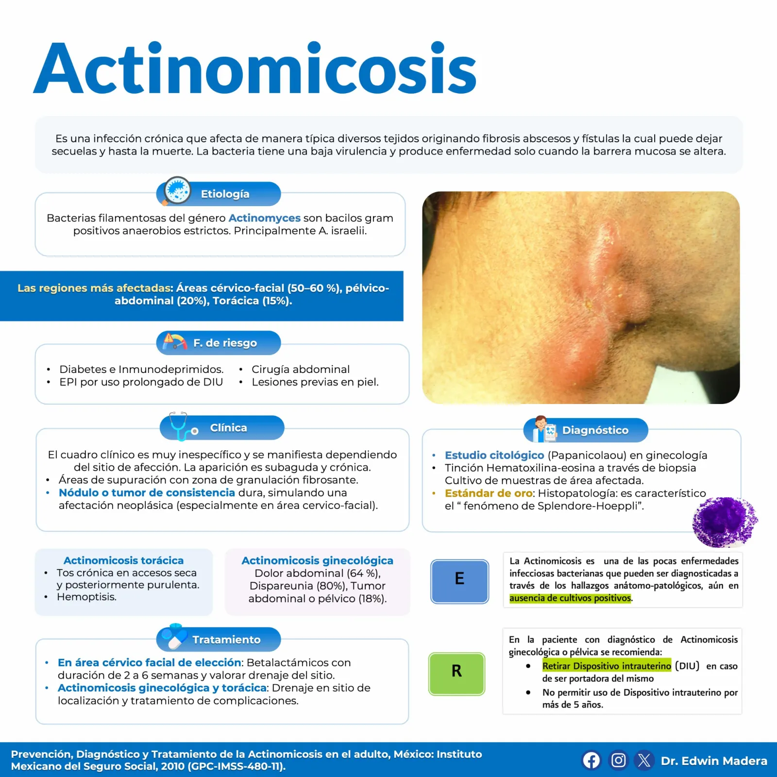 Actinomicosis