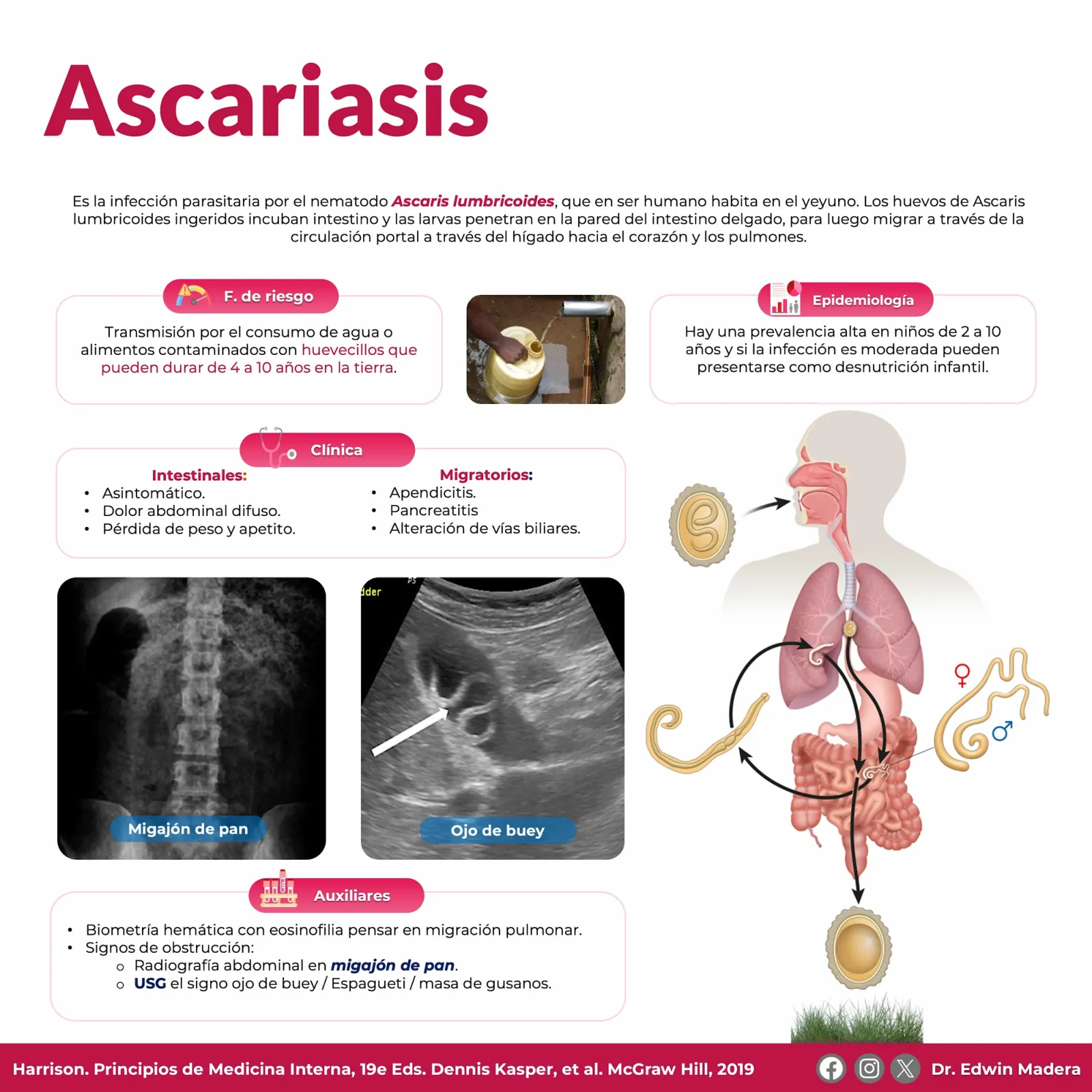 Ascariasis