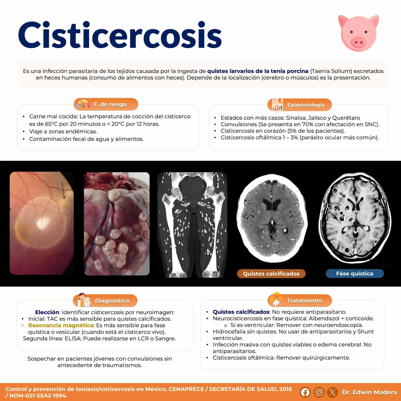 Cisticercosis