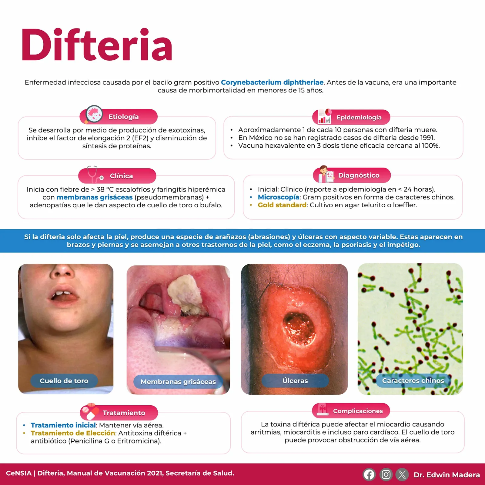 Difteria