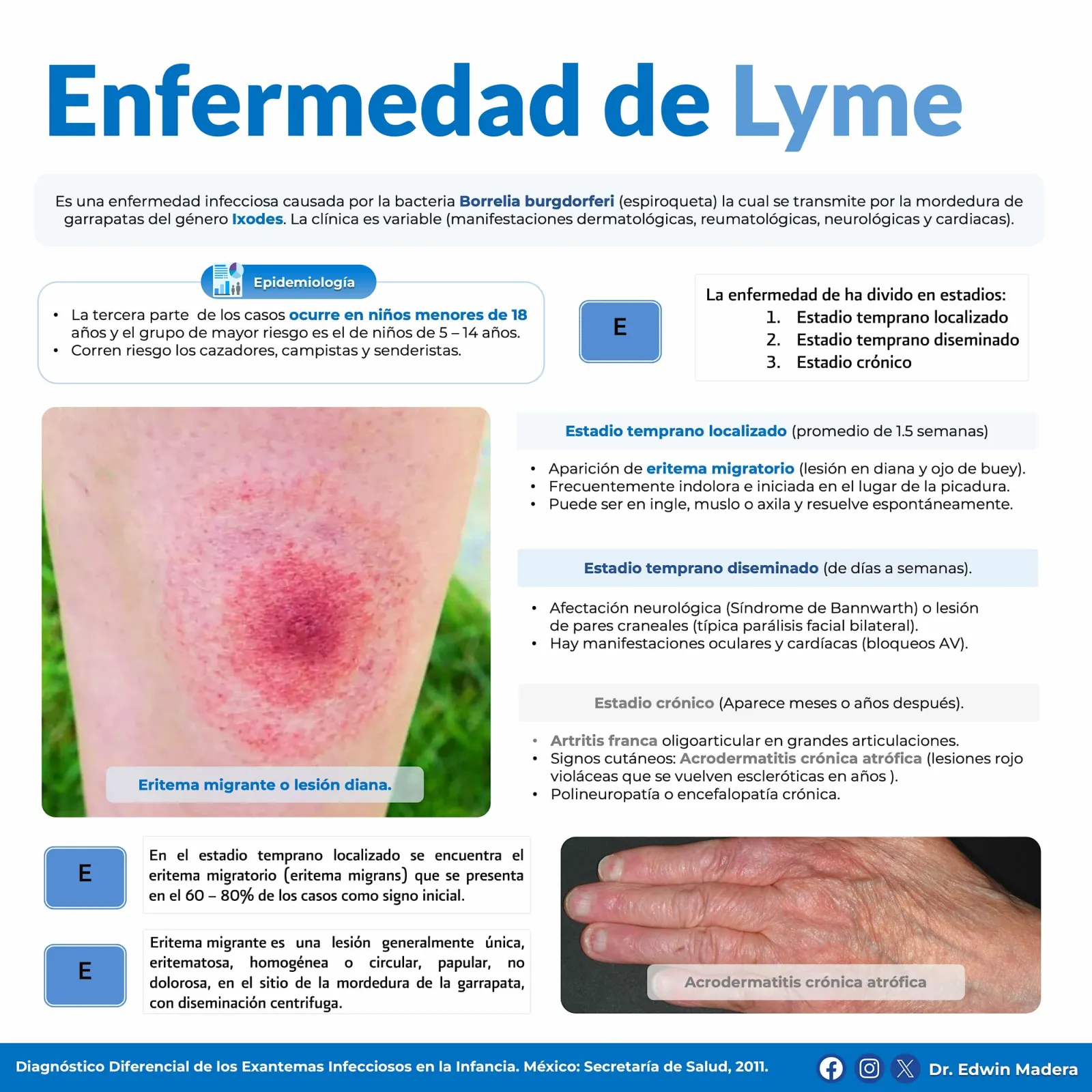 Enfermedad de Lyme