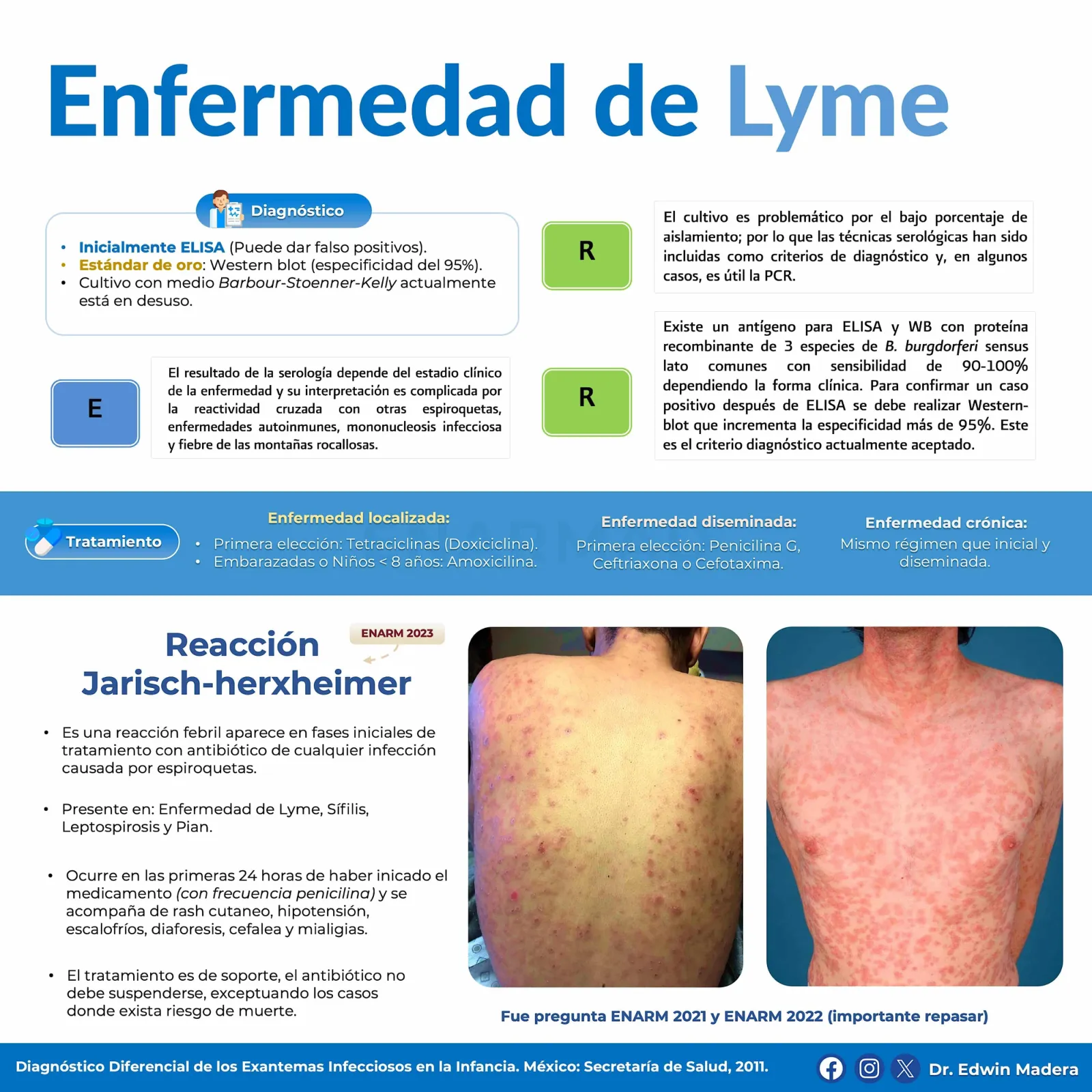 Enfermedad de Lyme