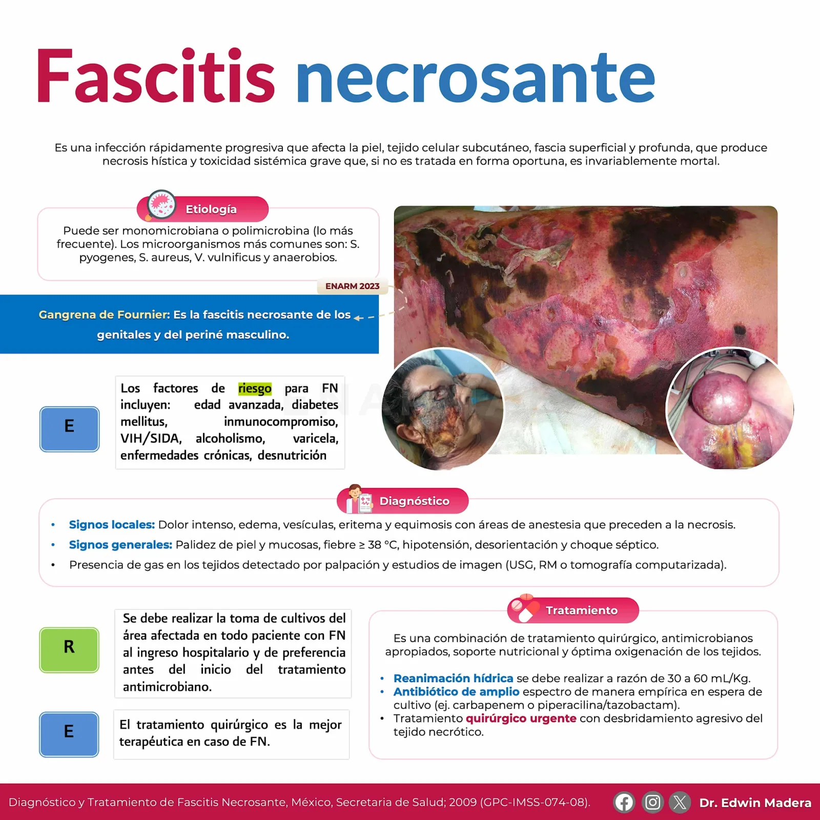 Fascitis necrosante