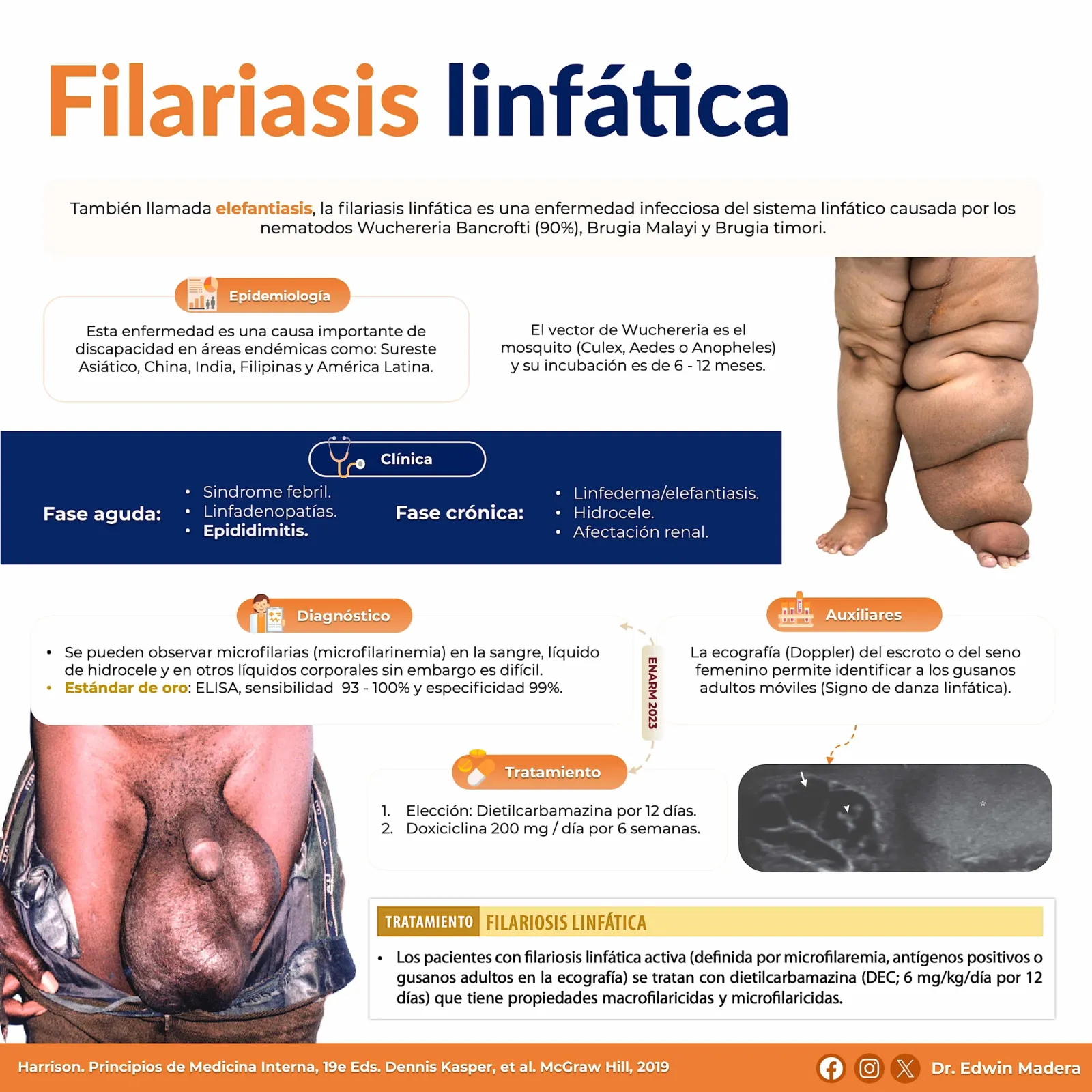 Filariasis linfática