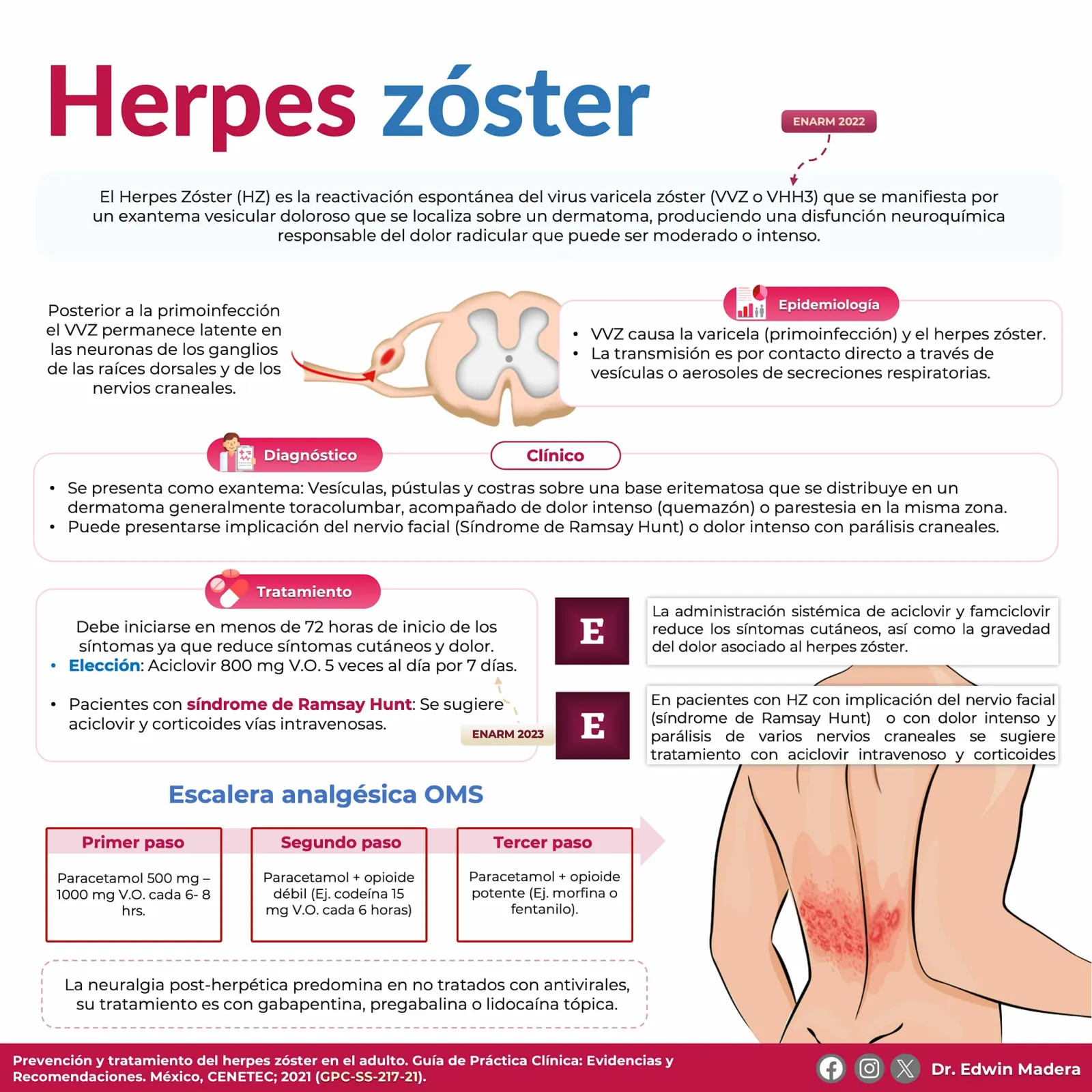 Herpes zóster