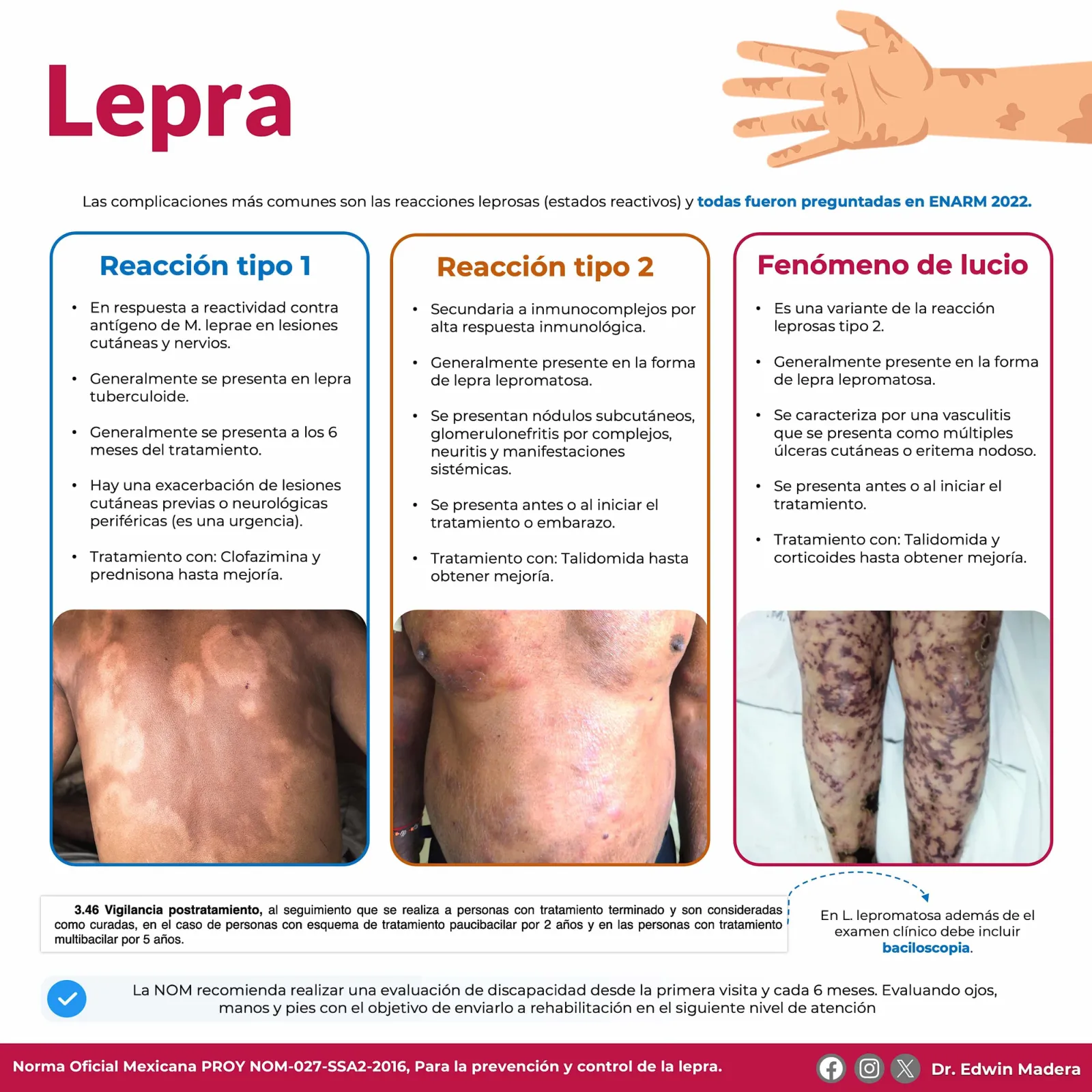 Lepra