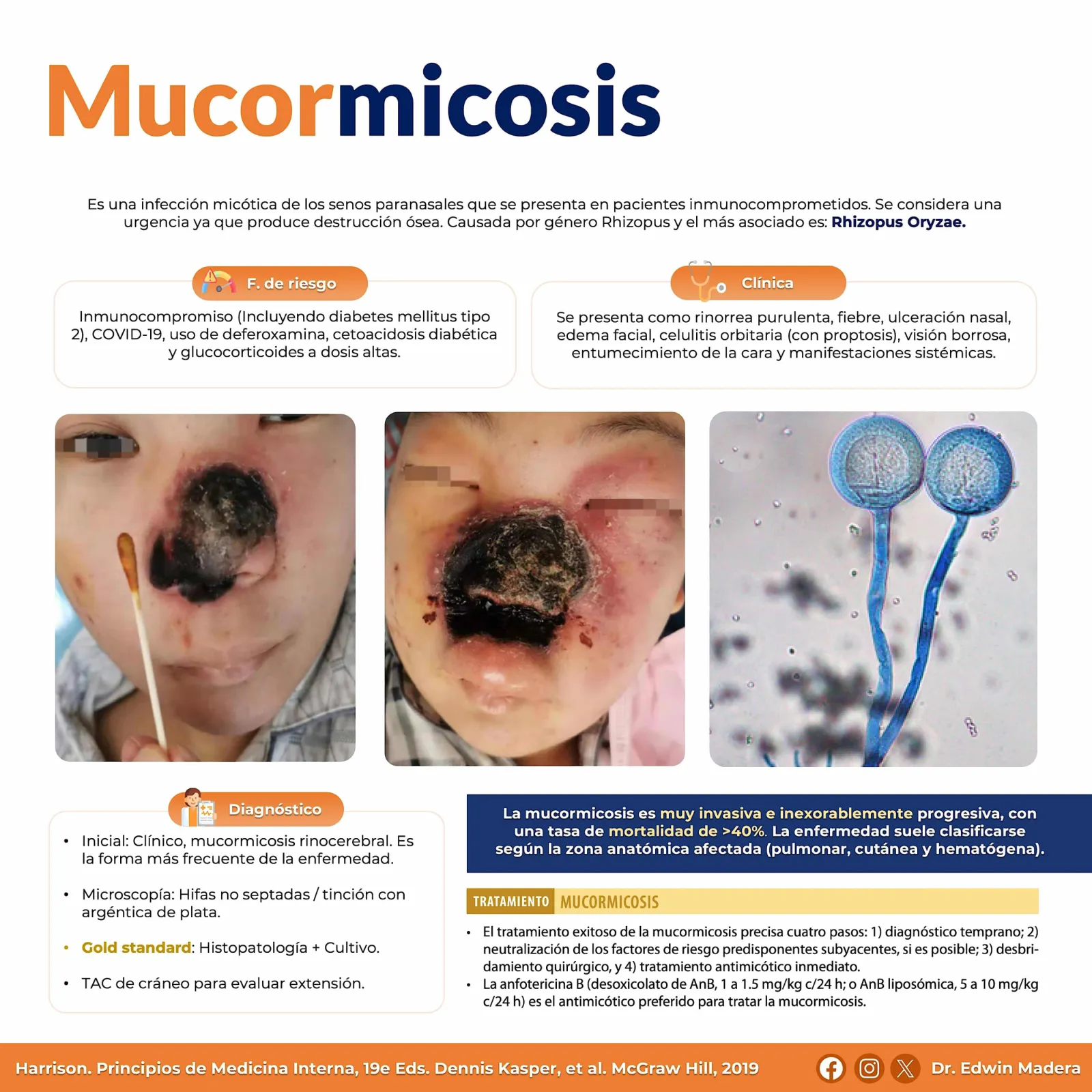 Mucormicosis