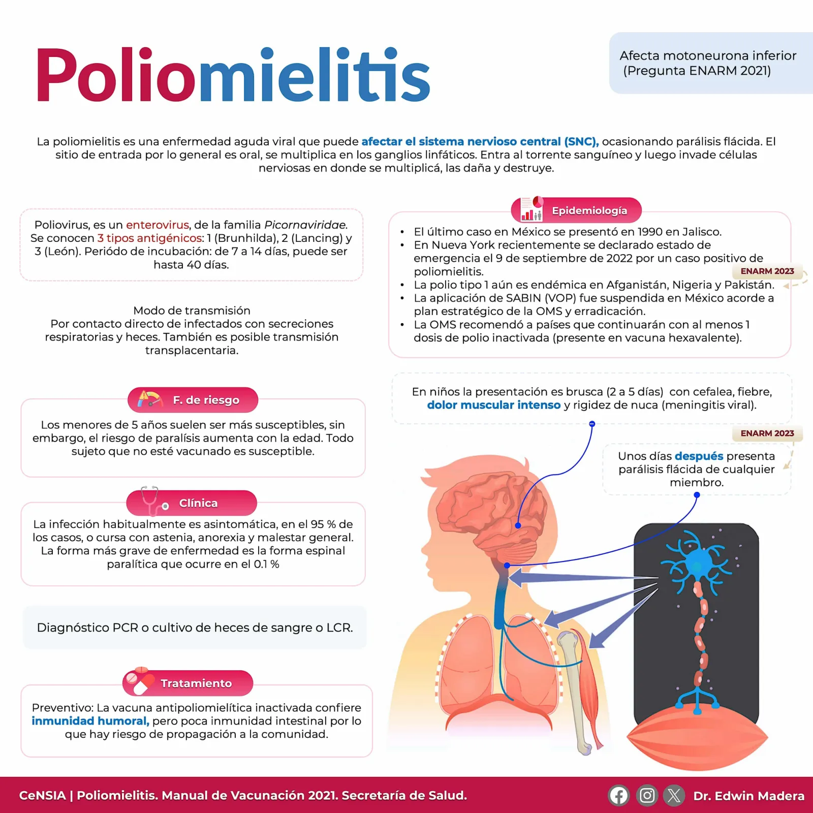 Poliomielitis