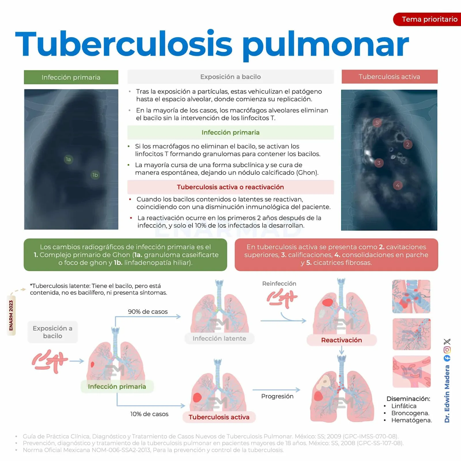 Tuberculosis pulmonar