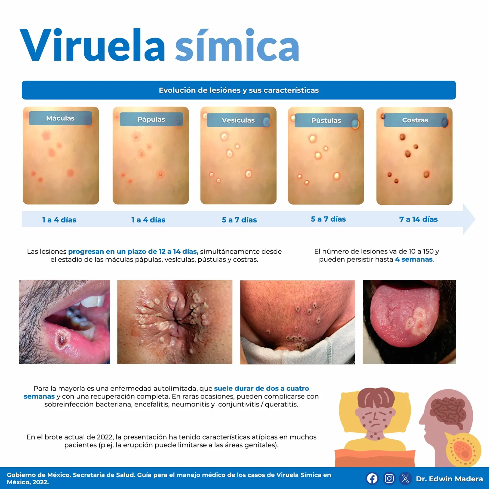 Viruela símica