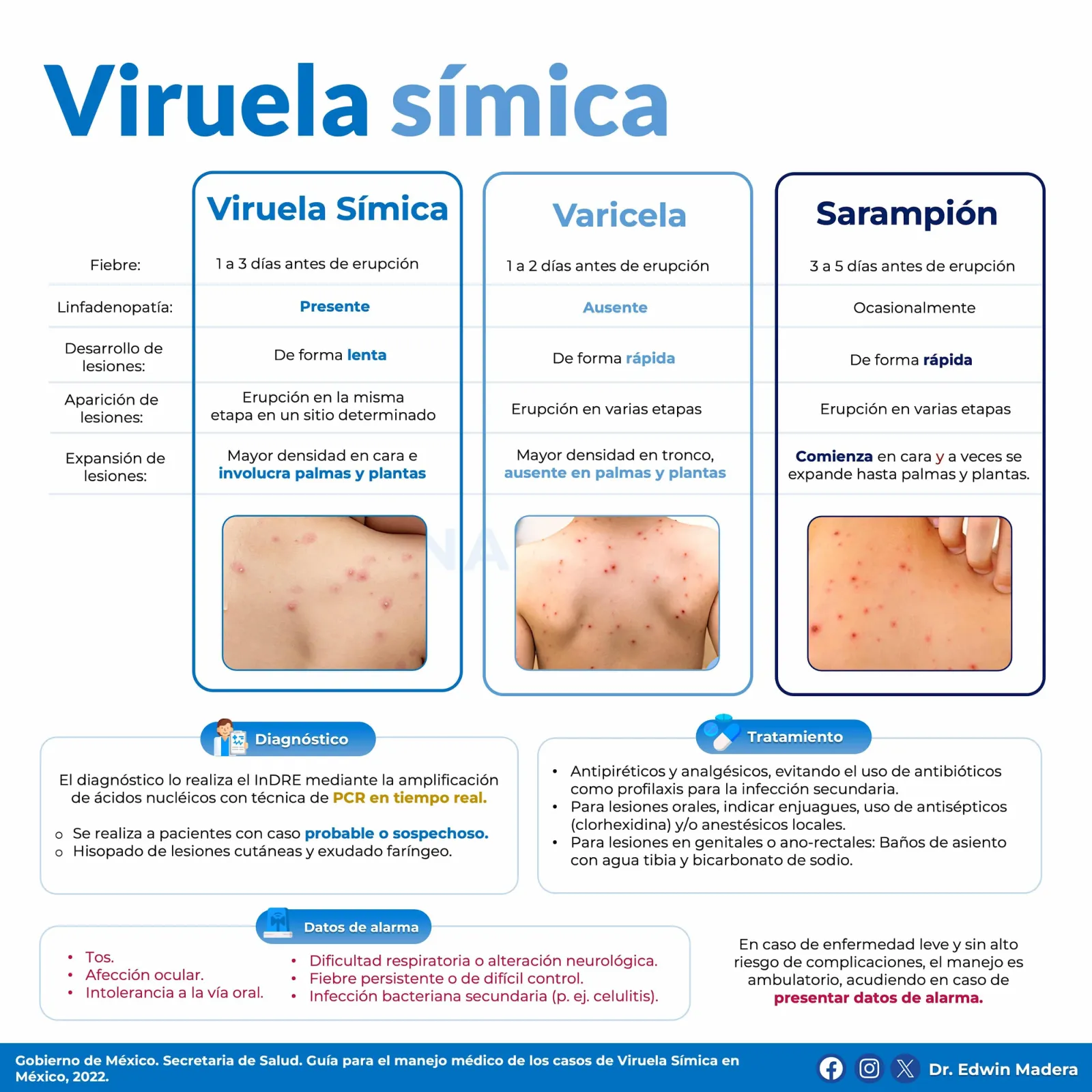 Viruela símica