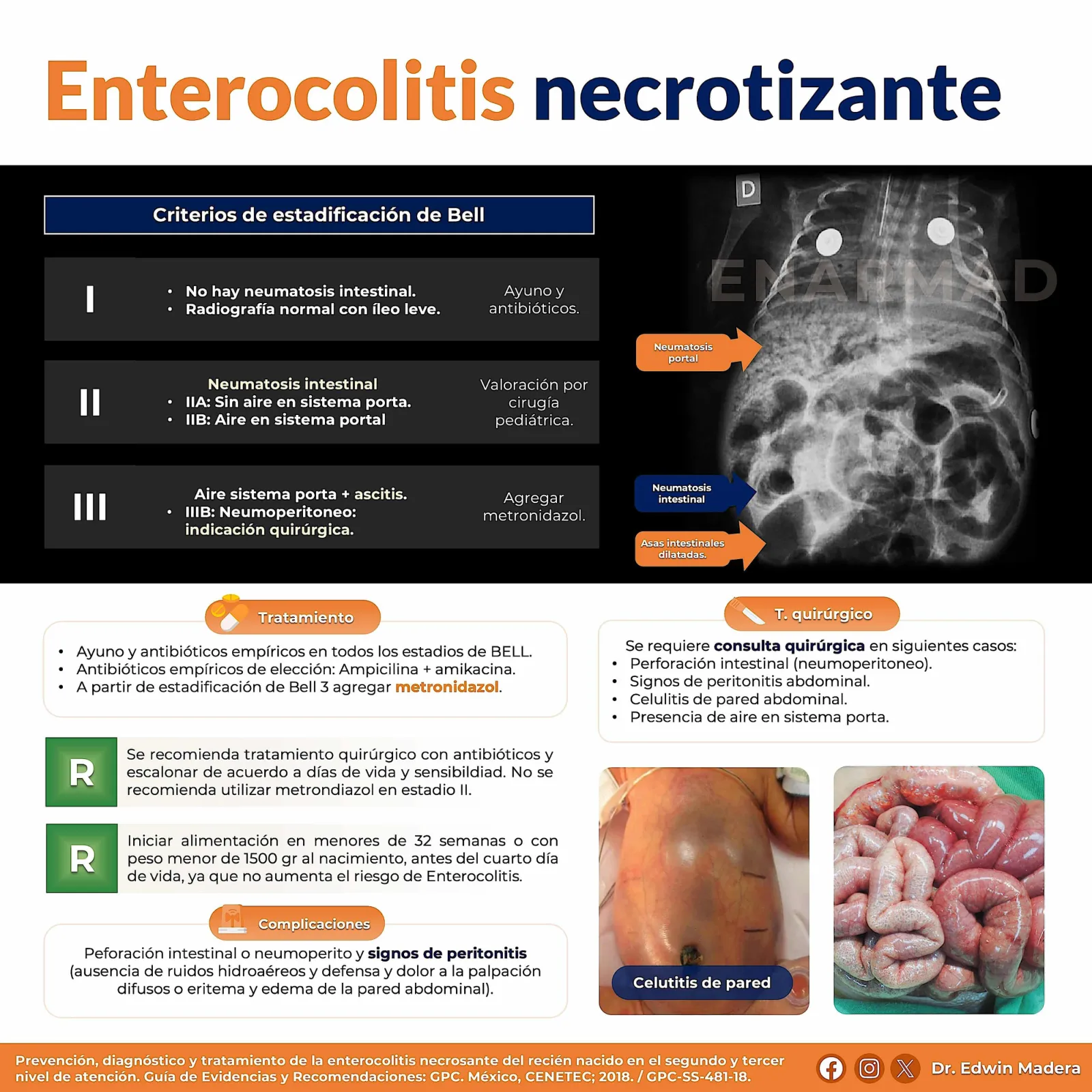 Enterocolitis necrotizante