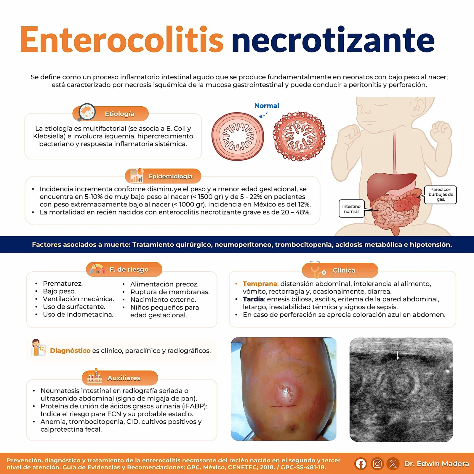 Enterocolitis necrotizante