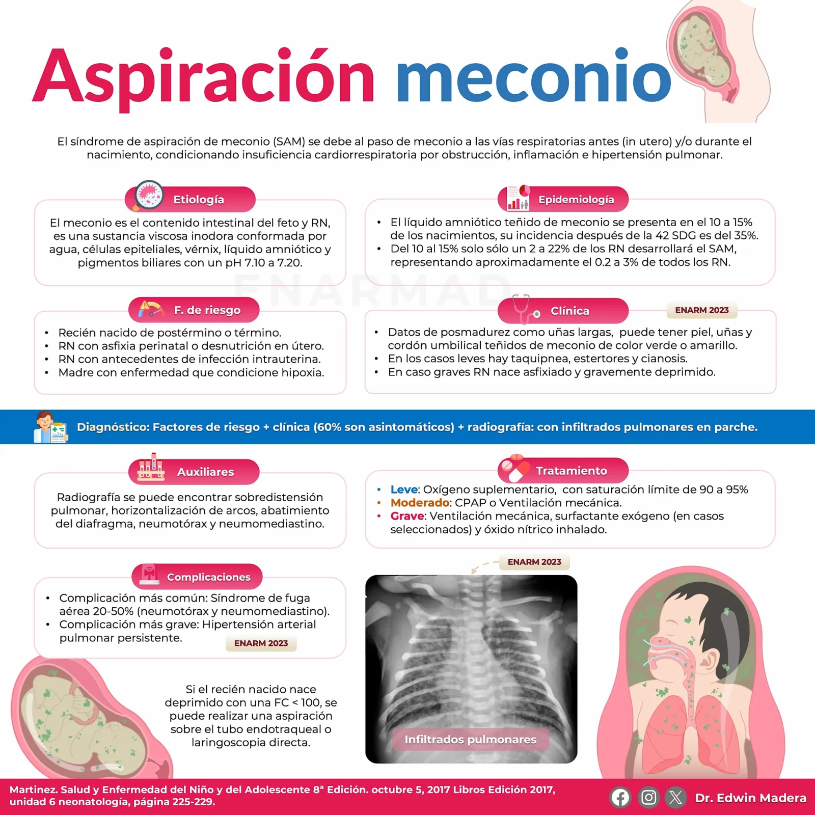 Síndrome de aspiración de meconio