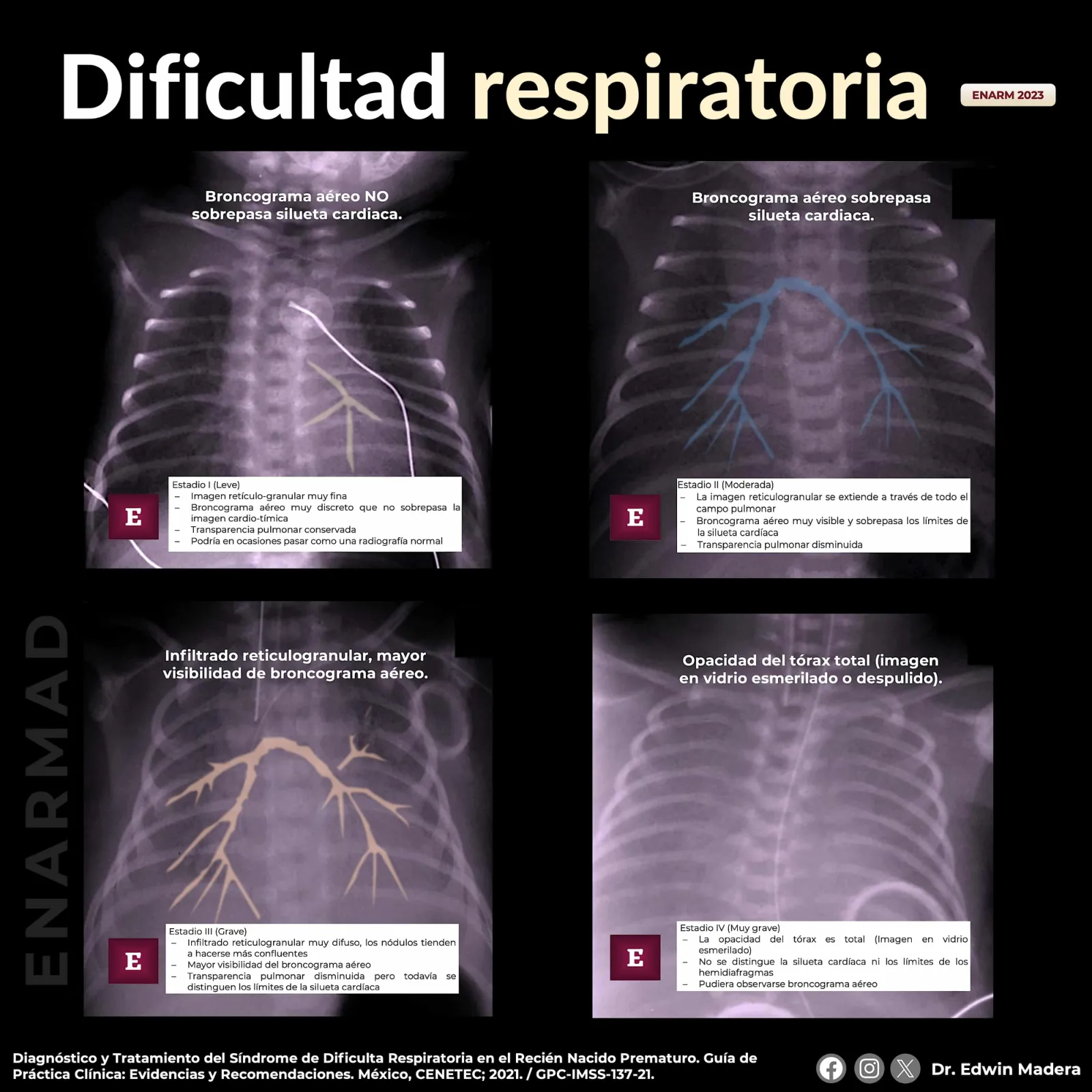 Síndrome de dificultad respiratoria