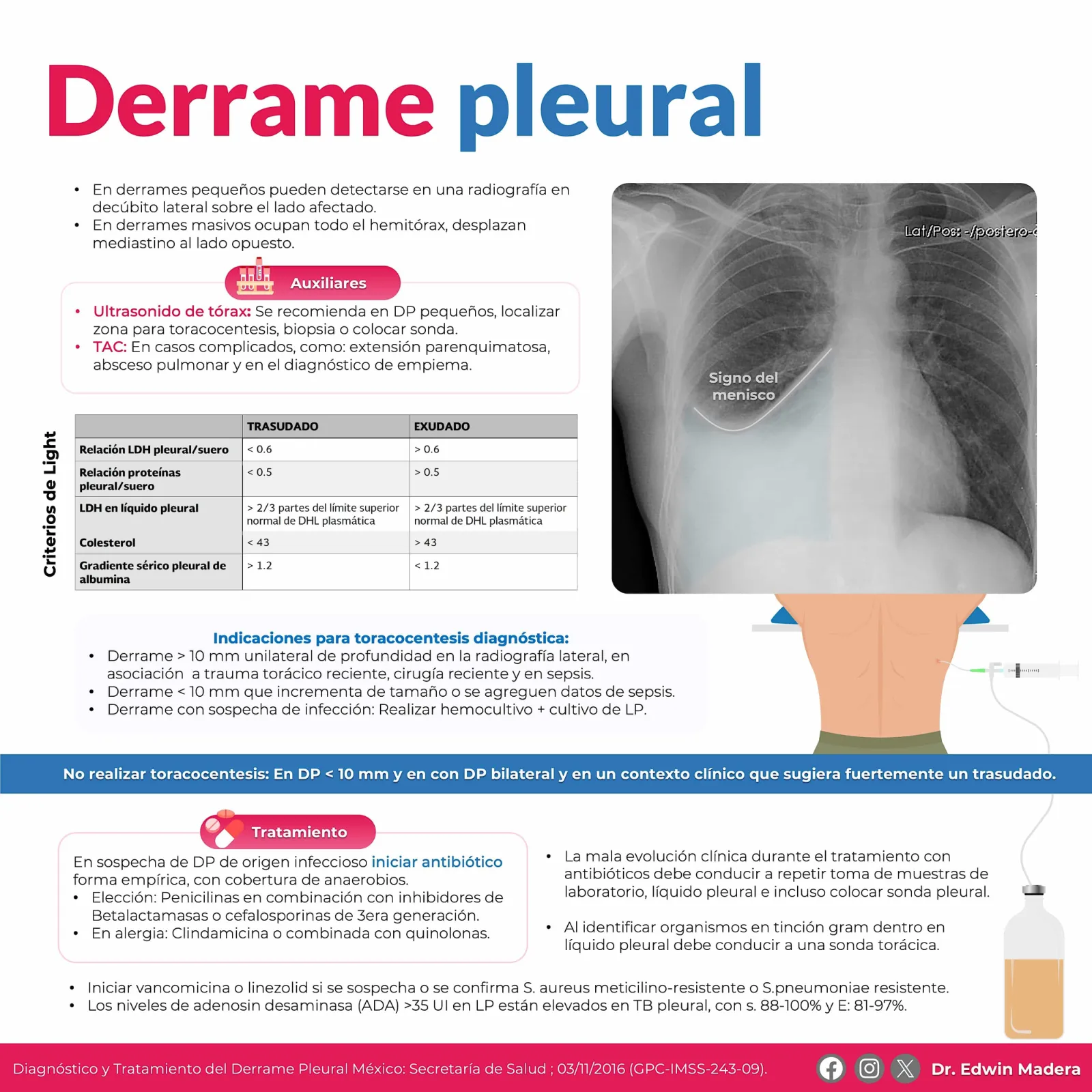 Derrame pleural