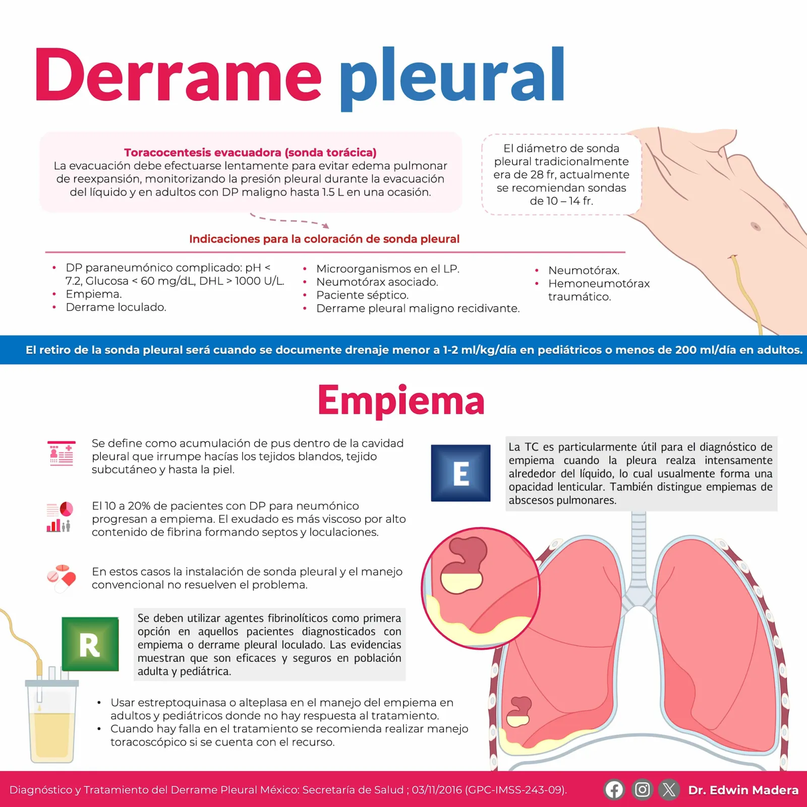 Derrame pleural
