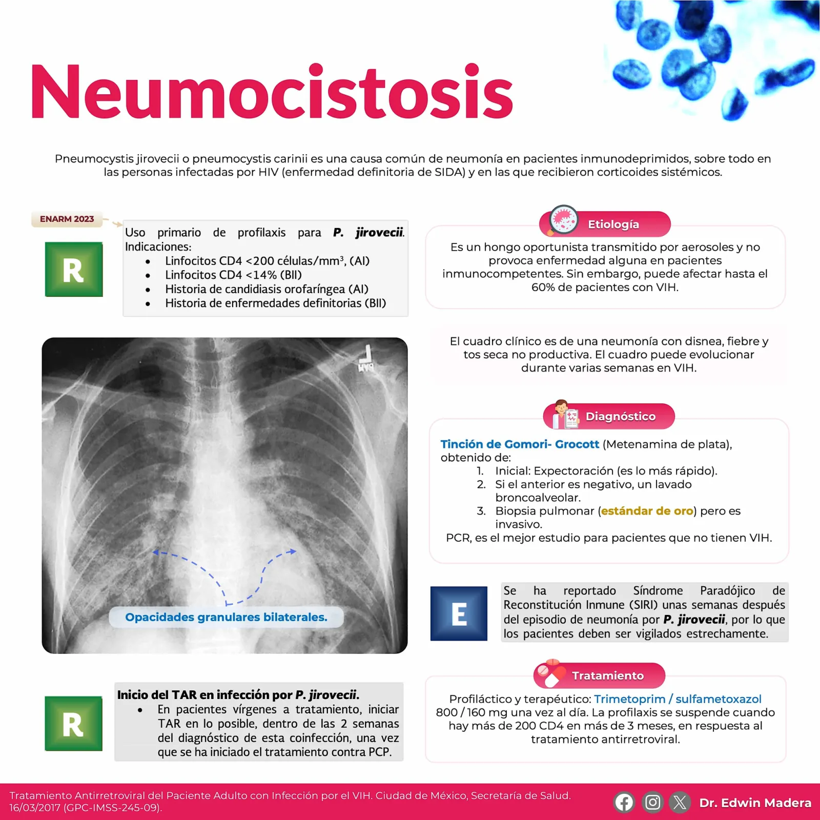 Neumocistosis