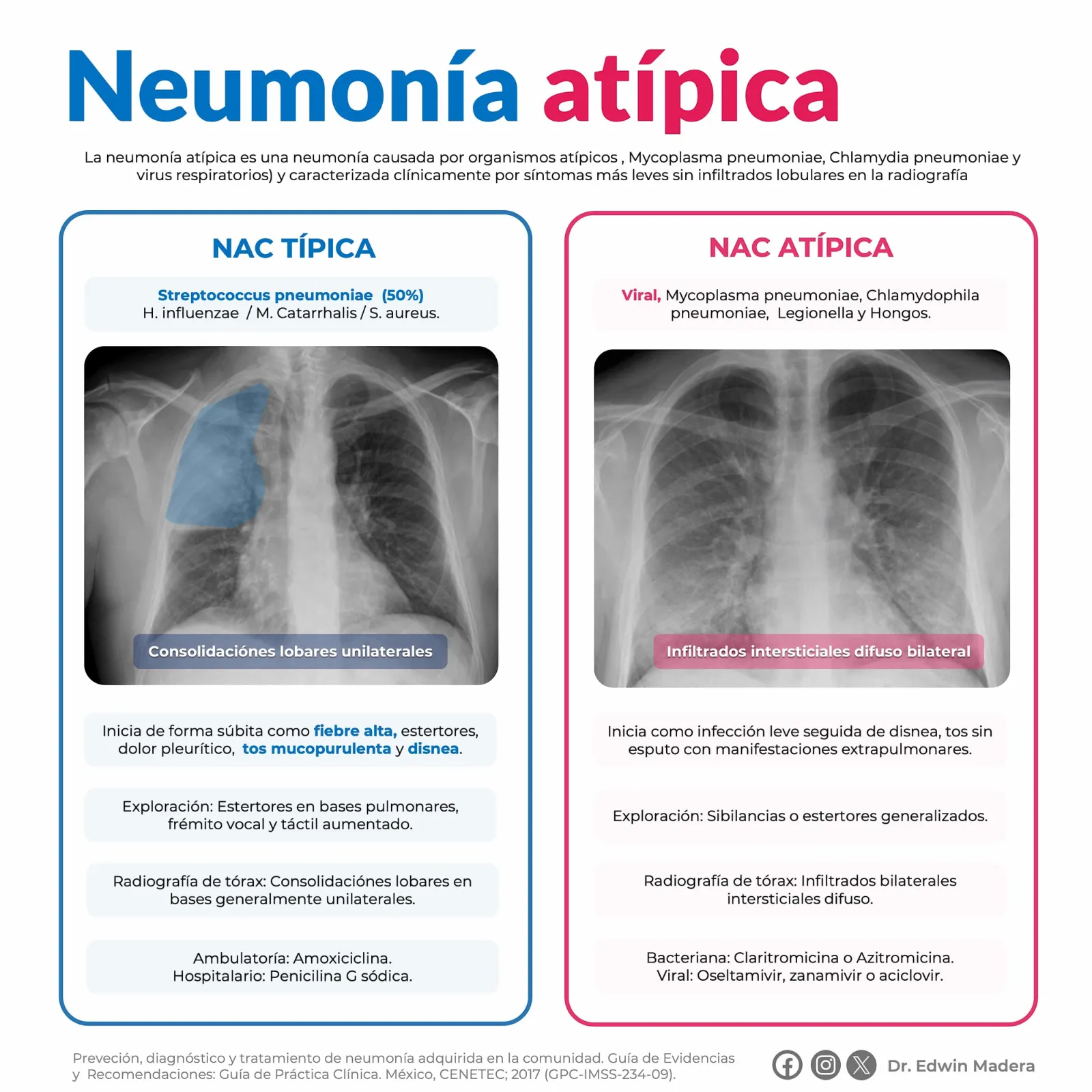 Neumonía atípica