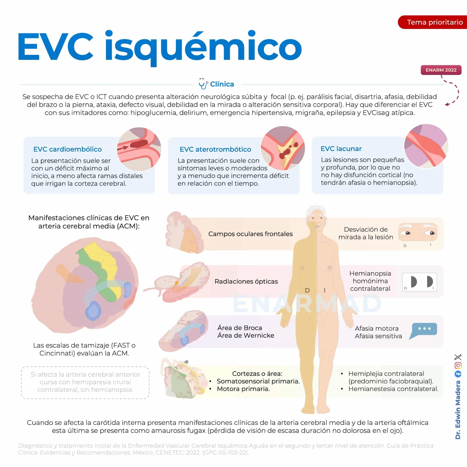 EVC isquémico