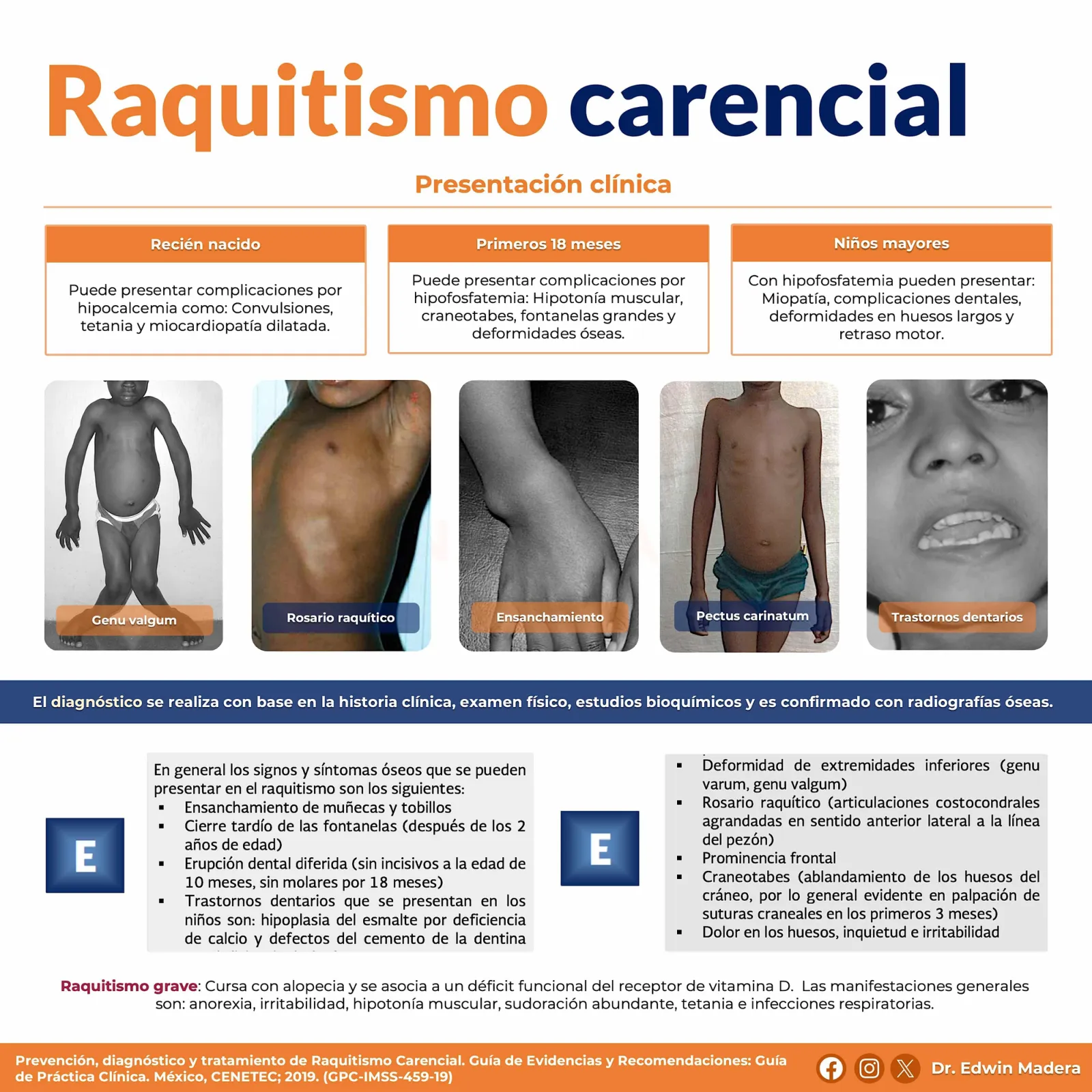 Raquitismo carencial