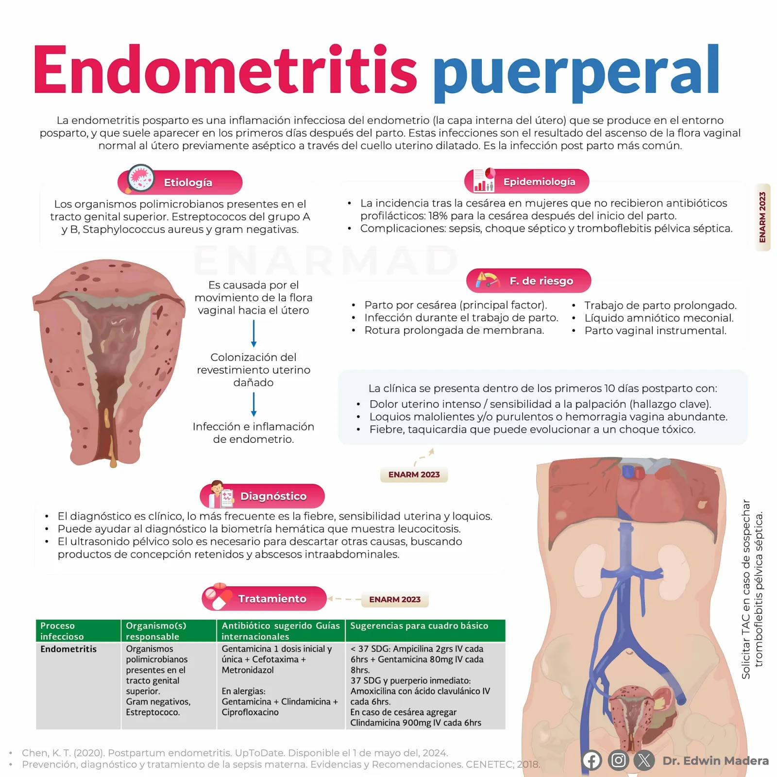 Endometritis puerperal
