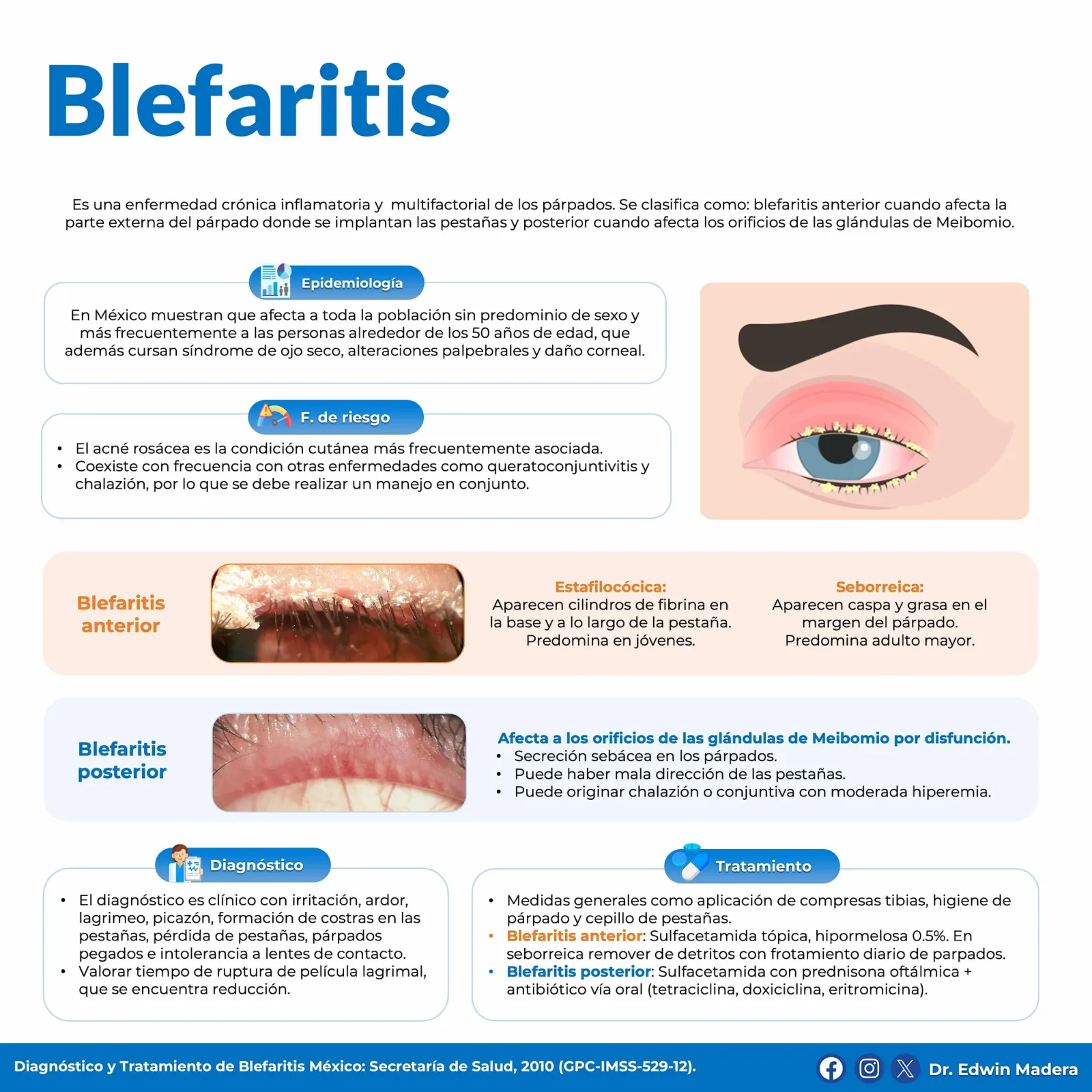 Blefaritis