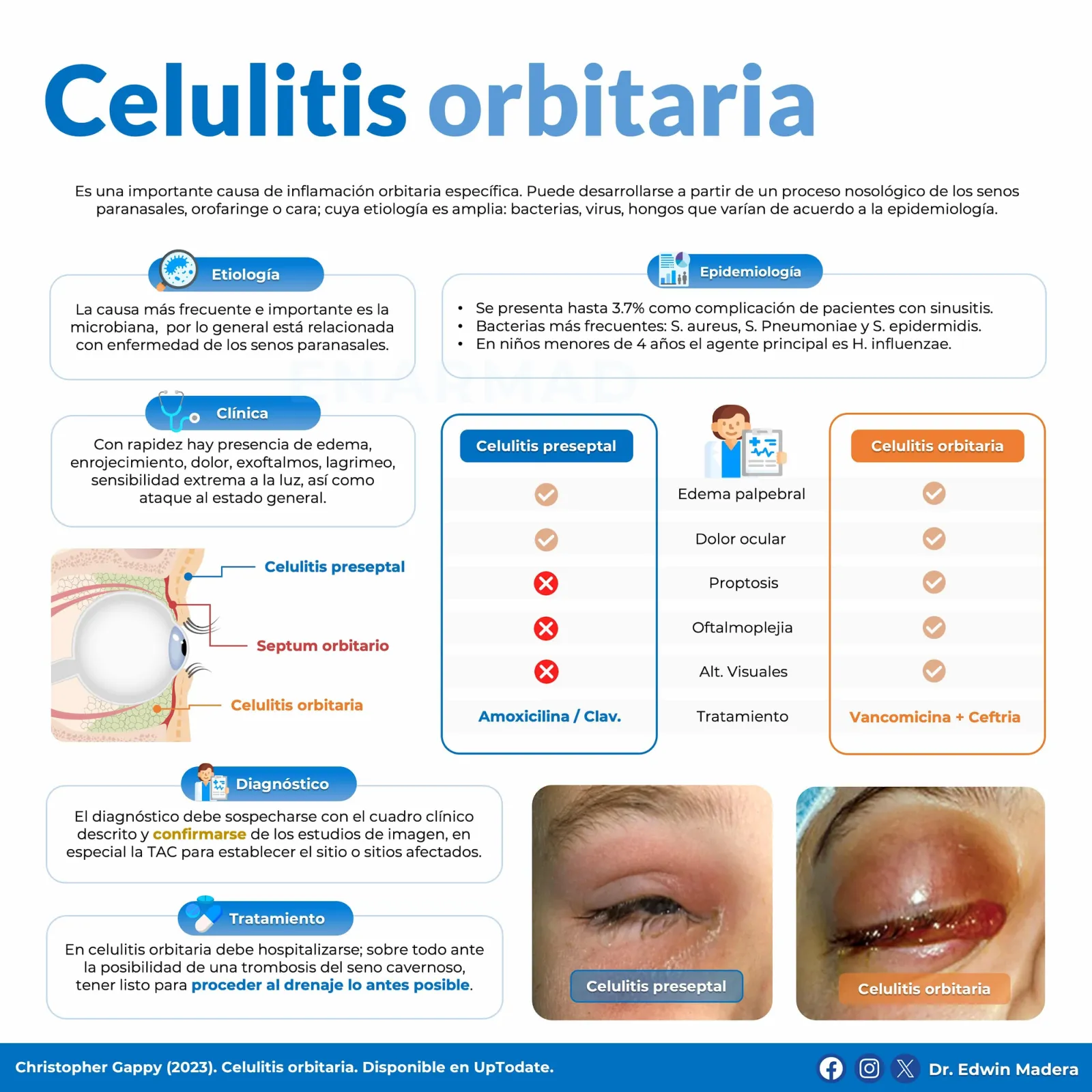 Celulitis orbitaria