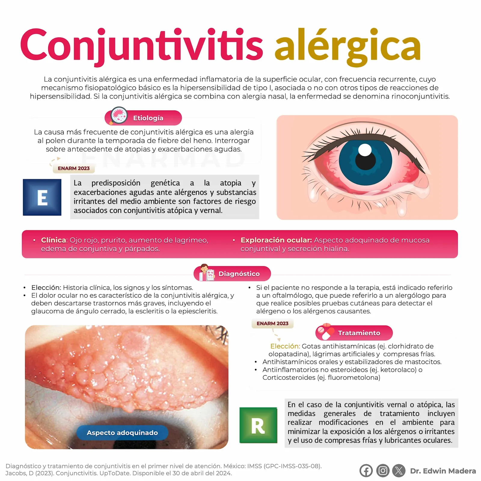 Conjuntivitis alérgica